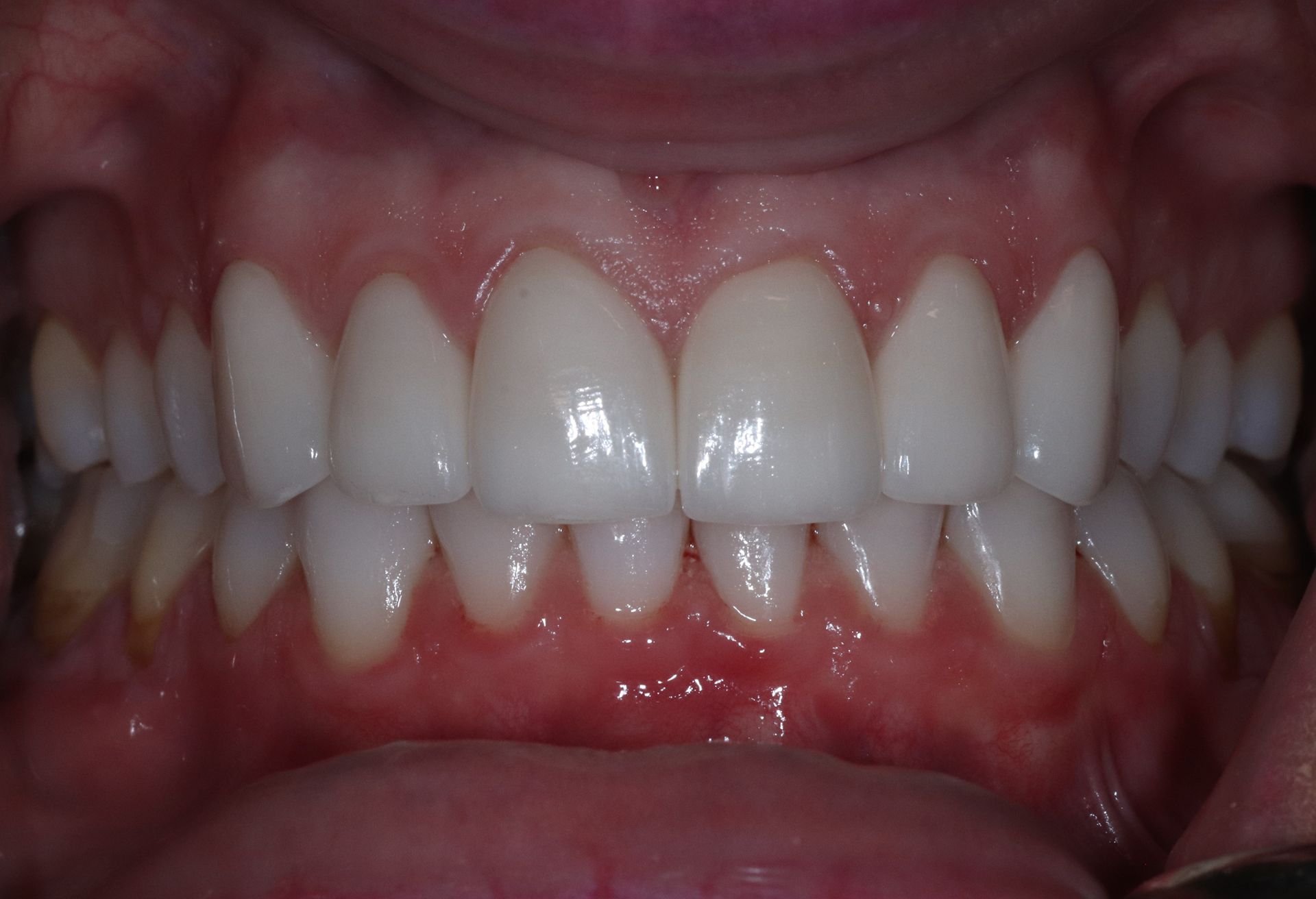 AFTER: Close-up of a person's mouth showing aligned white teeth and pink gums