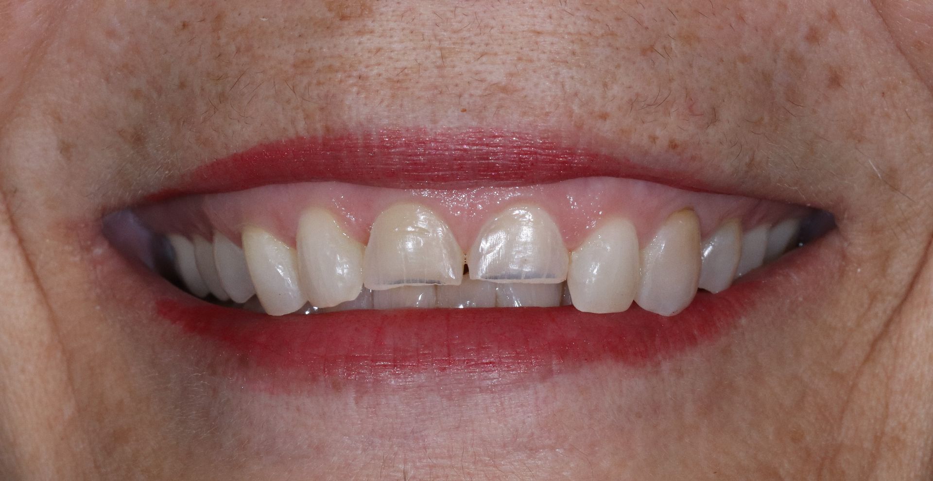 BEFORE: Close-up of a smiling mouth with teeth visible and red lipstick