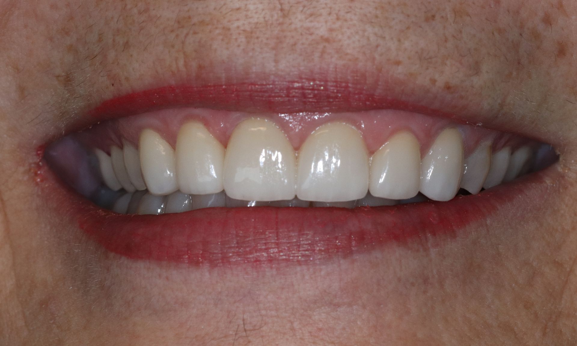 AFTER: Close-up of a smiling mouth with white teeth and red lipstick