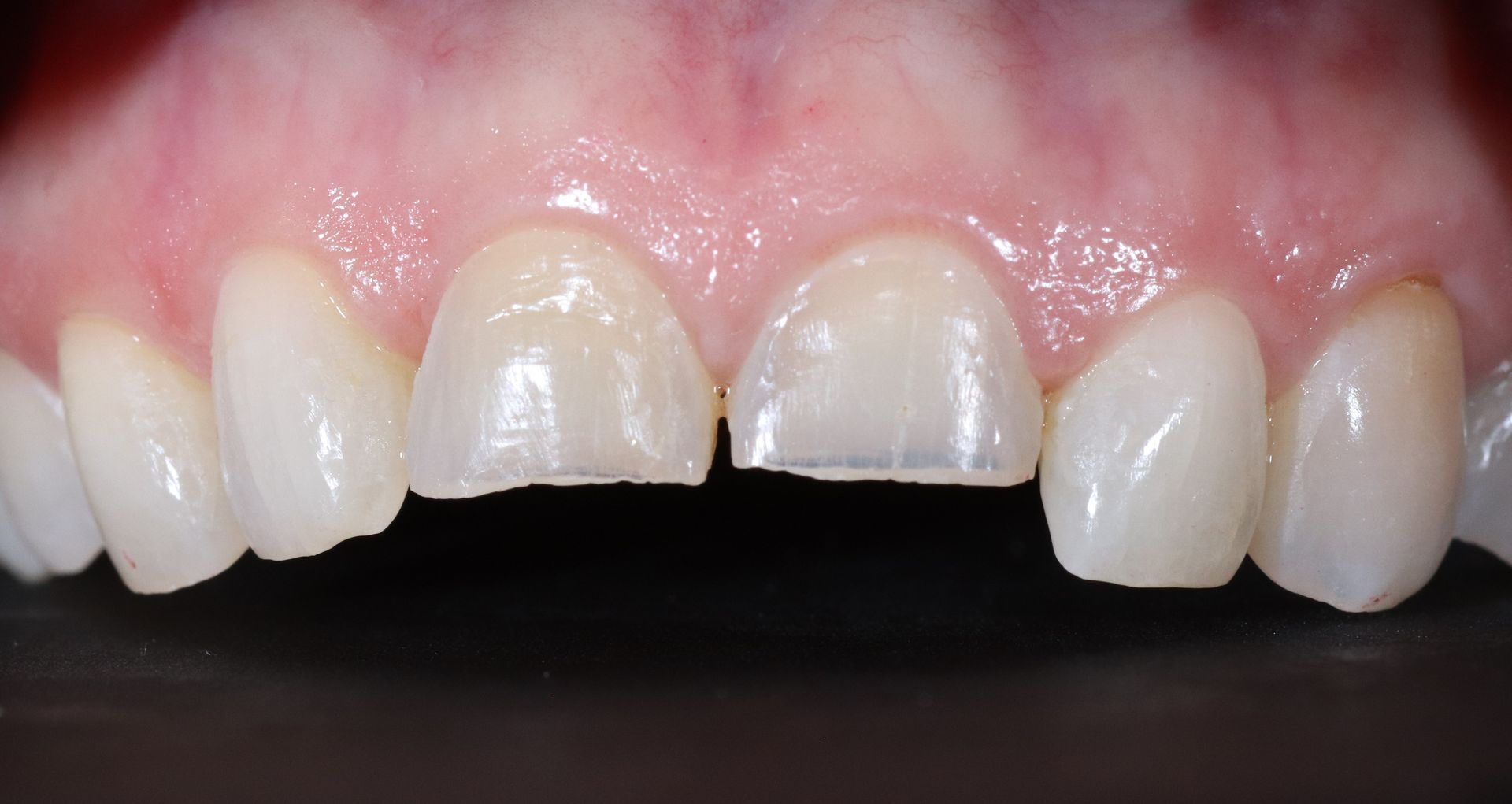 BEFORE: Close-up of upper front teeth with chipped enamel and pink gums