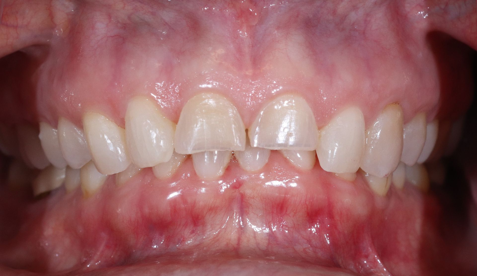 BEFORE: Close-up of a person’s mouth showing teeth and gums with a slight gap between the upper front teeth