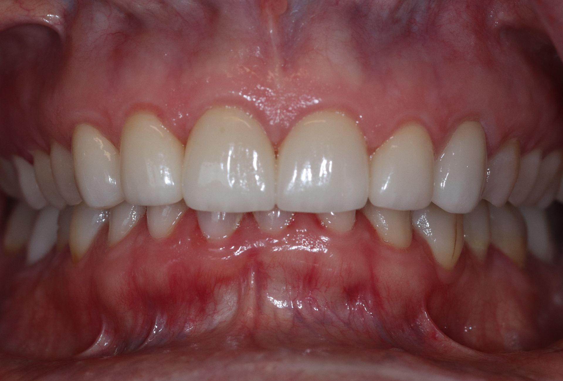 AFTER: Close-up of human teeth and gums with closed lips, showing upper and lower front teeth.