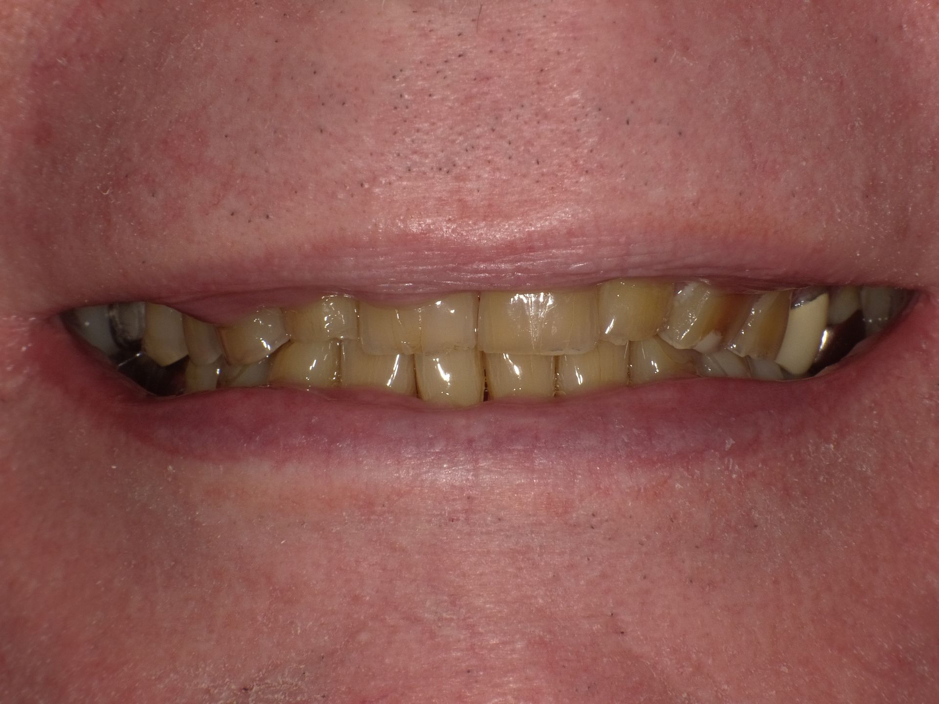 BEFORE: Close-up of a smiling mouth showing crooked yellowed teeth and a gap