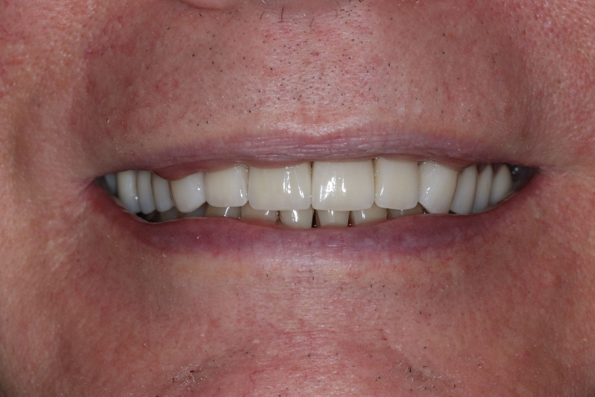 AFTER: Close-up of a smiling mouth showing straight white teeth and lips