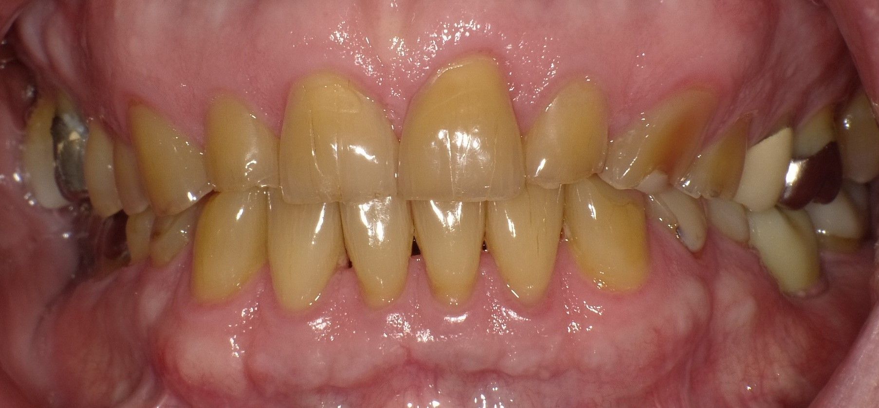 BEFORE: Close-up of misaligned teeth with yellowing and gum recession