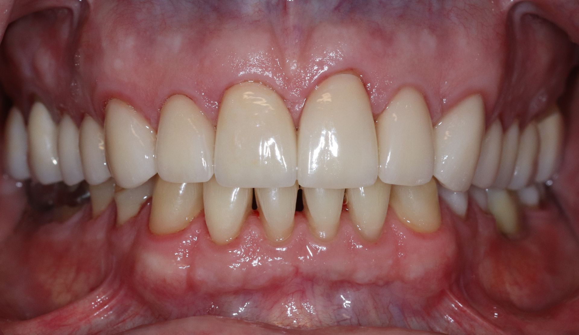 AFTER: Close-up of teeth and gums with visible dental crowding and gaps
