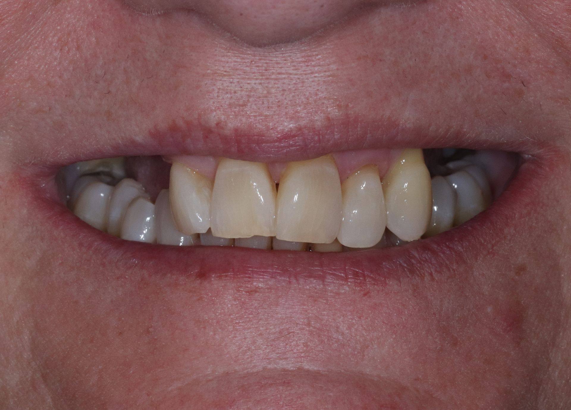 Close-up of a smiling mouth showing teeth and gums