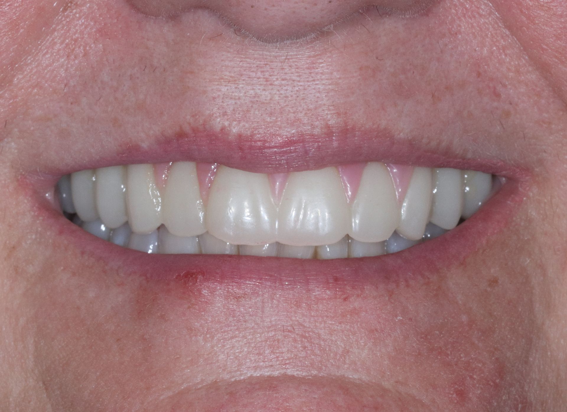 Close-up of a smiling mouth showing white teeth and pink gums
