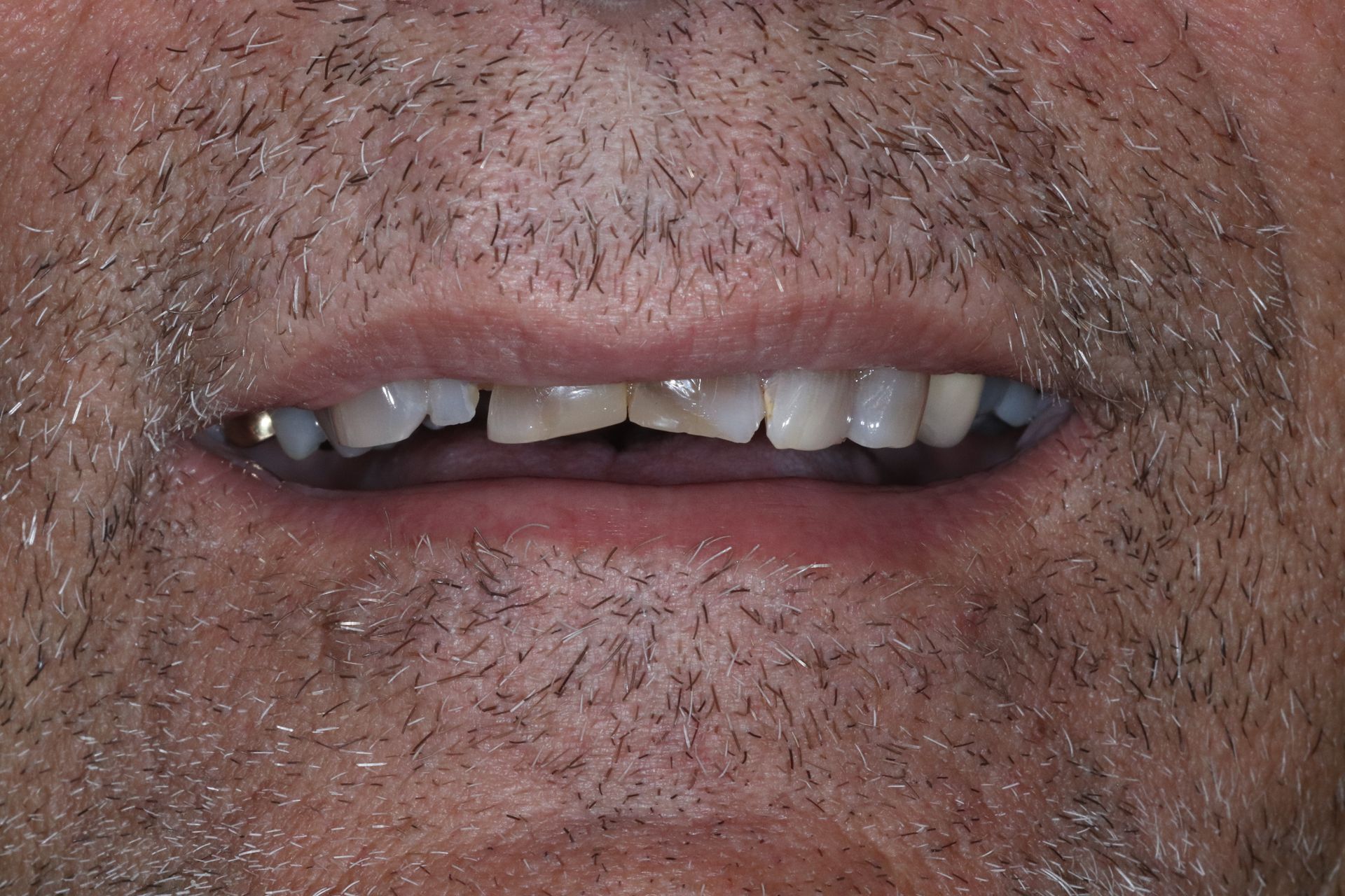 BEFORE: Close-up of a person's mouth with lips slightly parted, showing teeth and facial stubble.