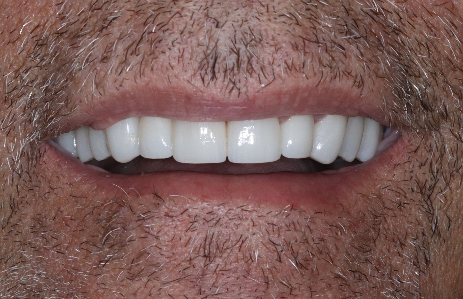 AFTER: Close-up of a smiling mouth with bright white teeth and facial stubble