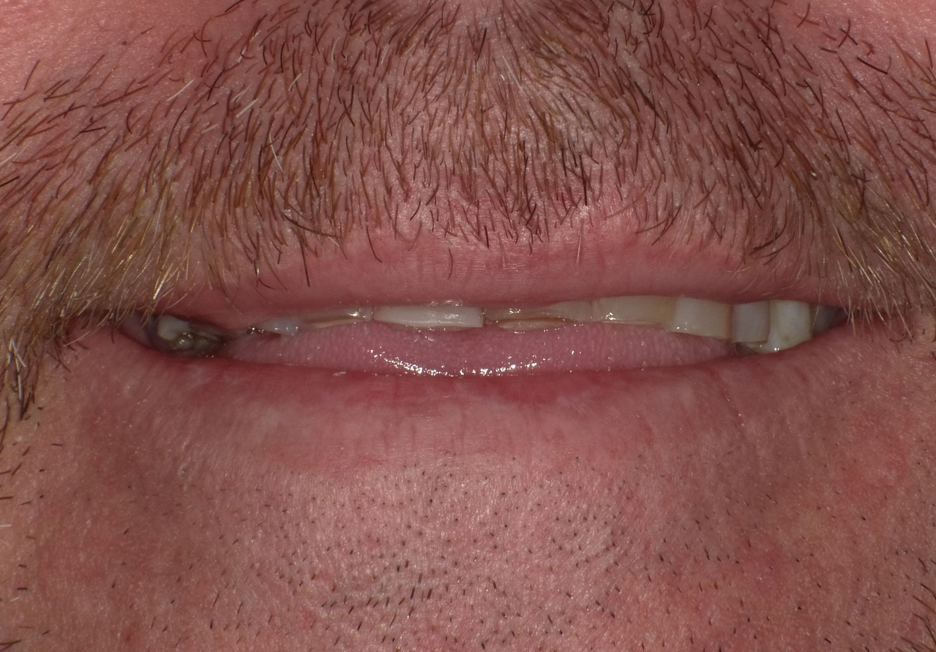 BEFORE: Close-up of a smiling mouth with lips parted, showing teeth and facial hair.