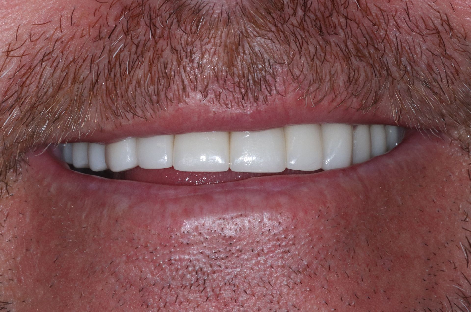 AFTER: Close-up of a smiling mouth with white teeth and visible mustache stubble