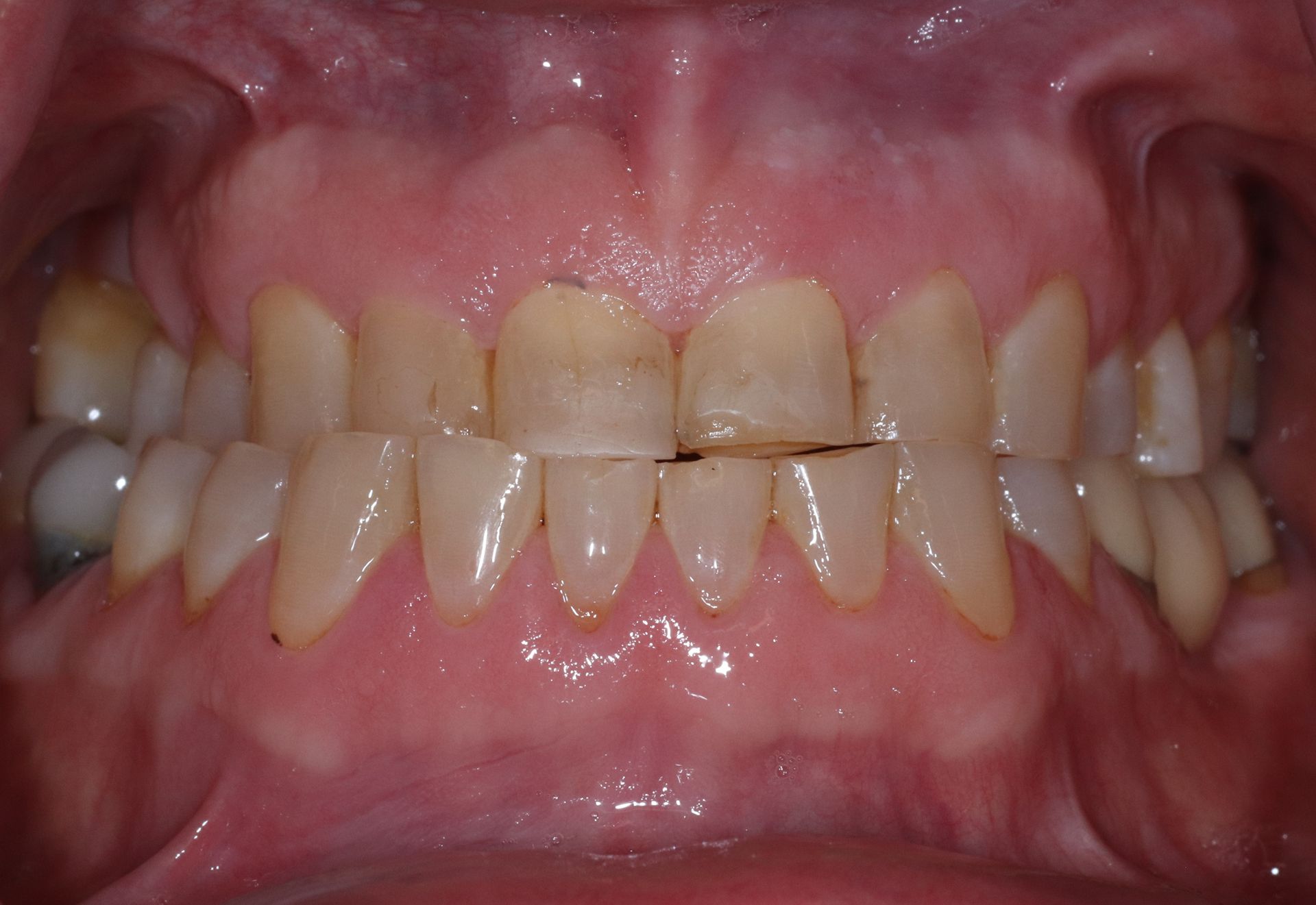 BEFORE: Close-up of misaligned teeth and gums with visible discoloration in a mouth