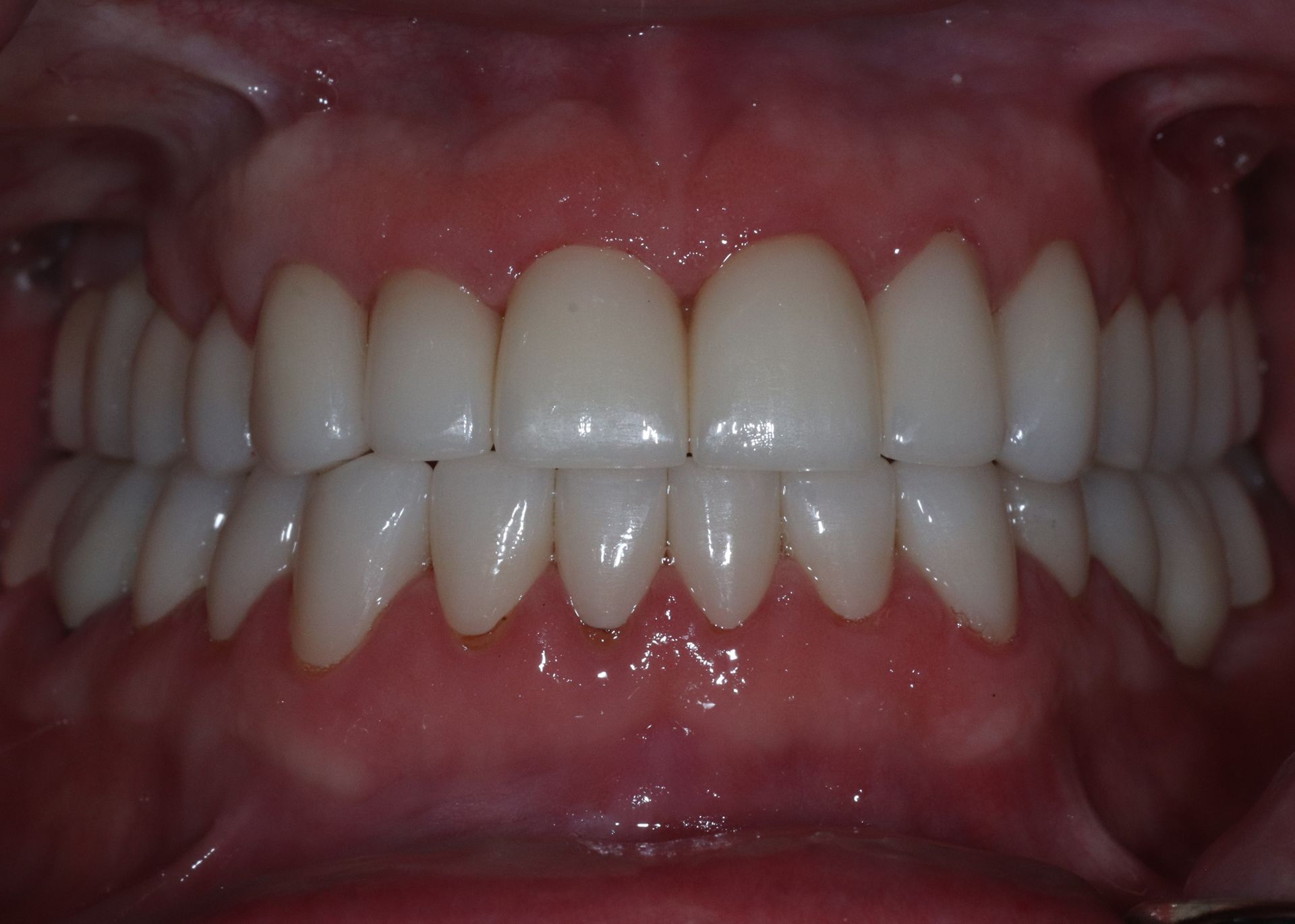 AFTER: Close-up of teeth and gums, showing a full set of white dentures or artificial teeth in a mouth