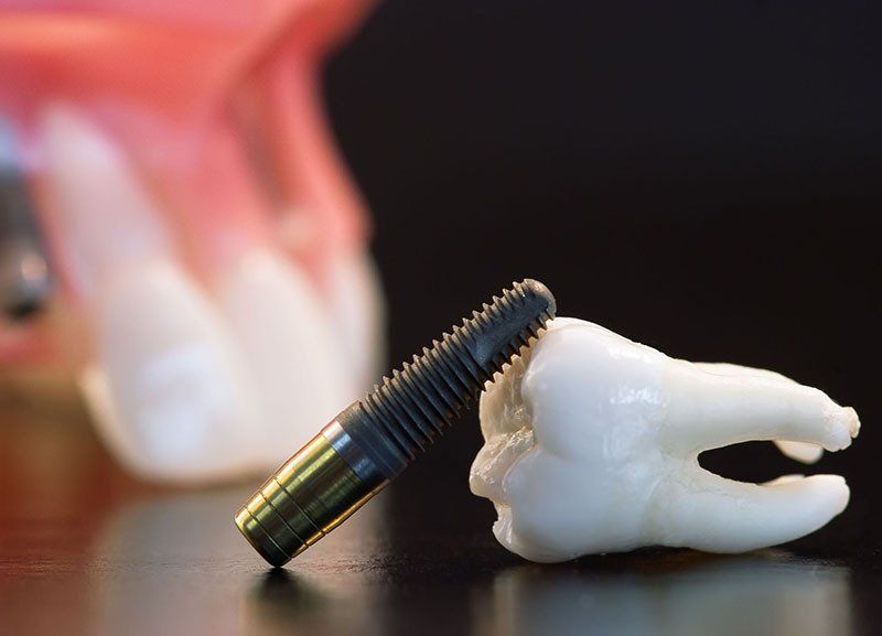 Dental implants