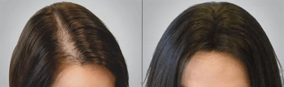 PRP hair treatment for women