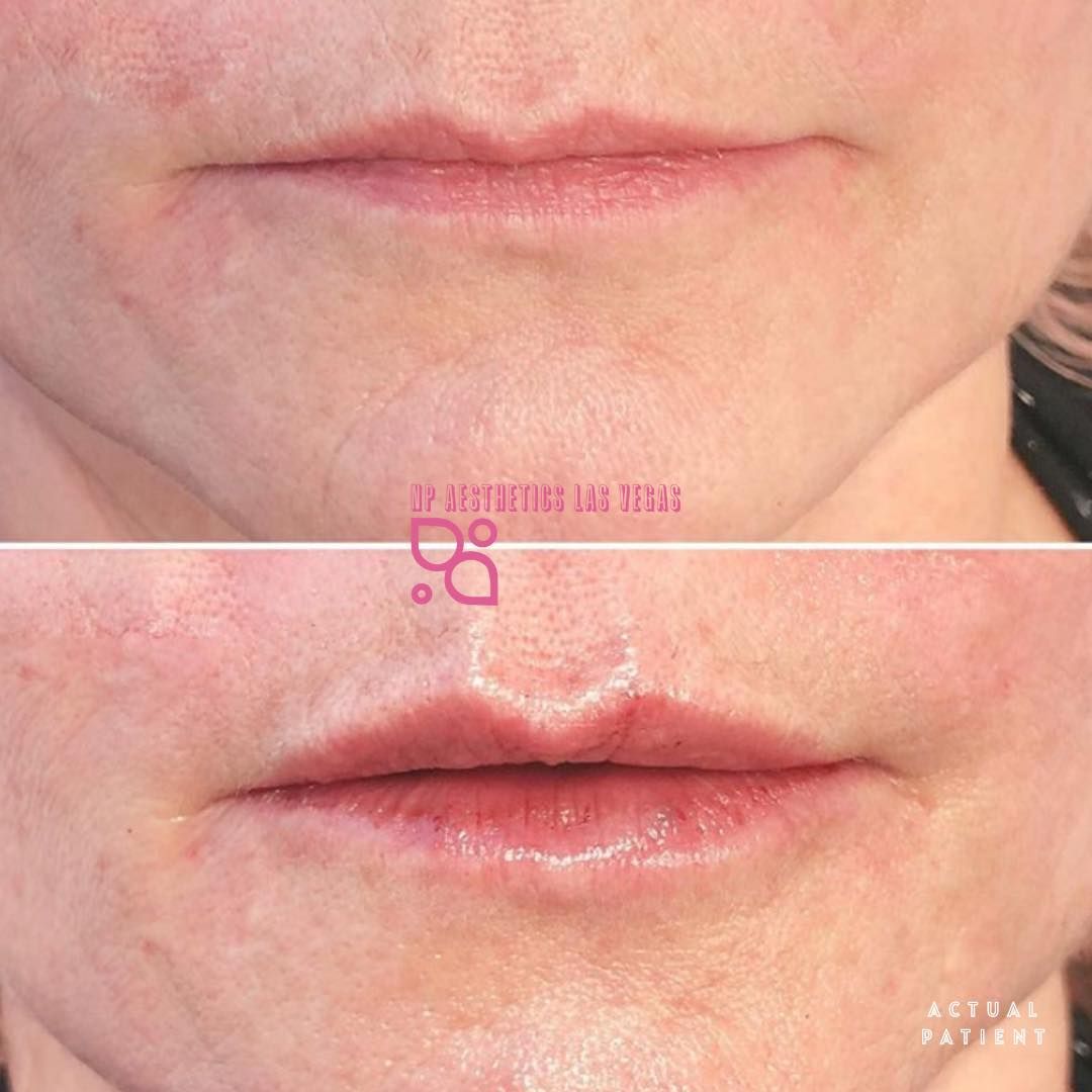A before and after photo of a woman 's lips.