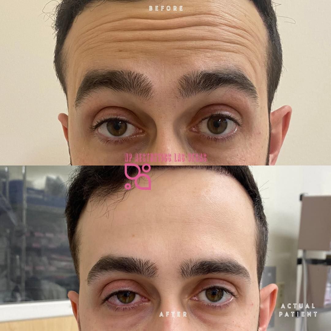 A before and after photo of a man 's forehead