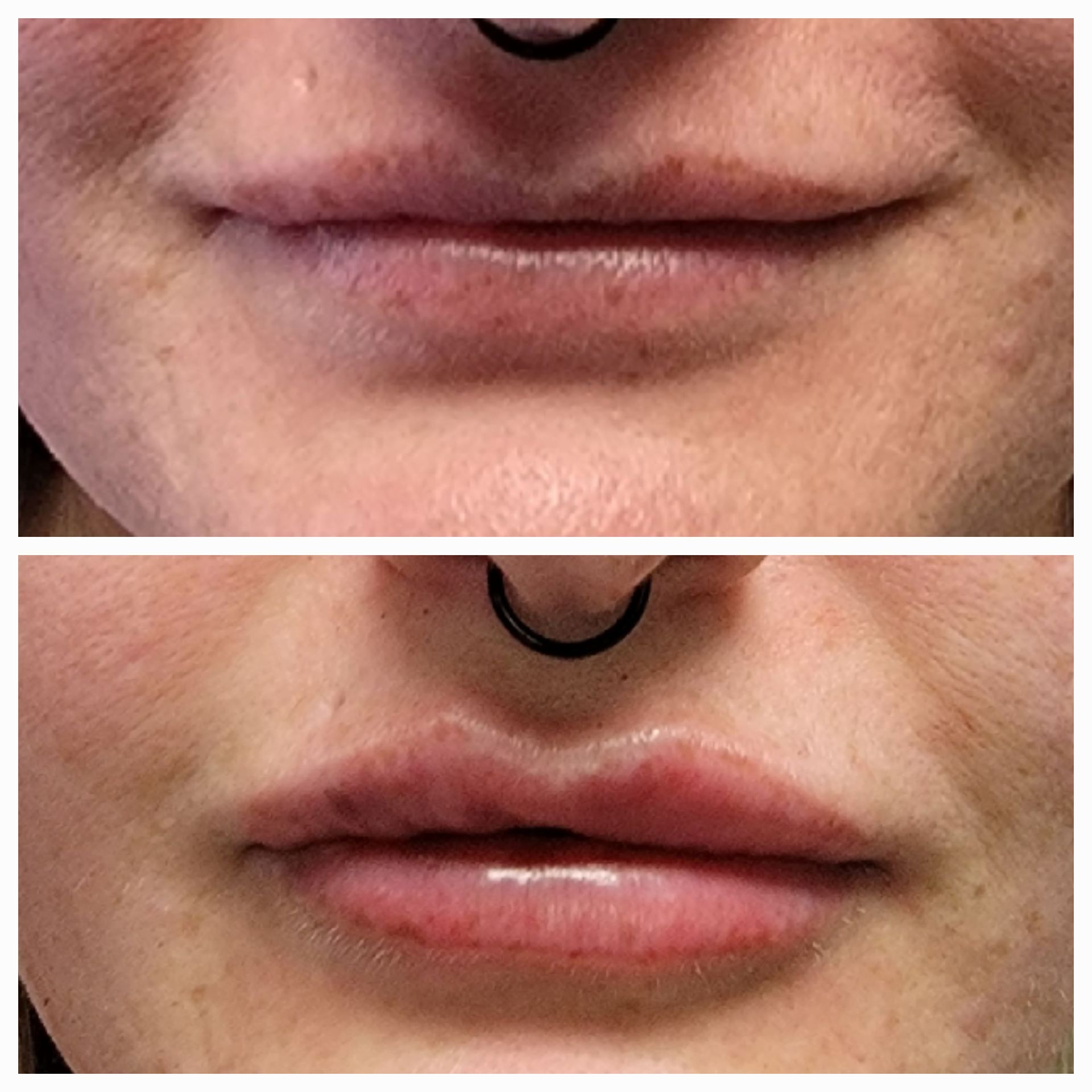 Close-up of lips before and after filler, with fuller lips shown below.