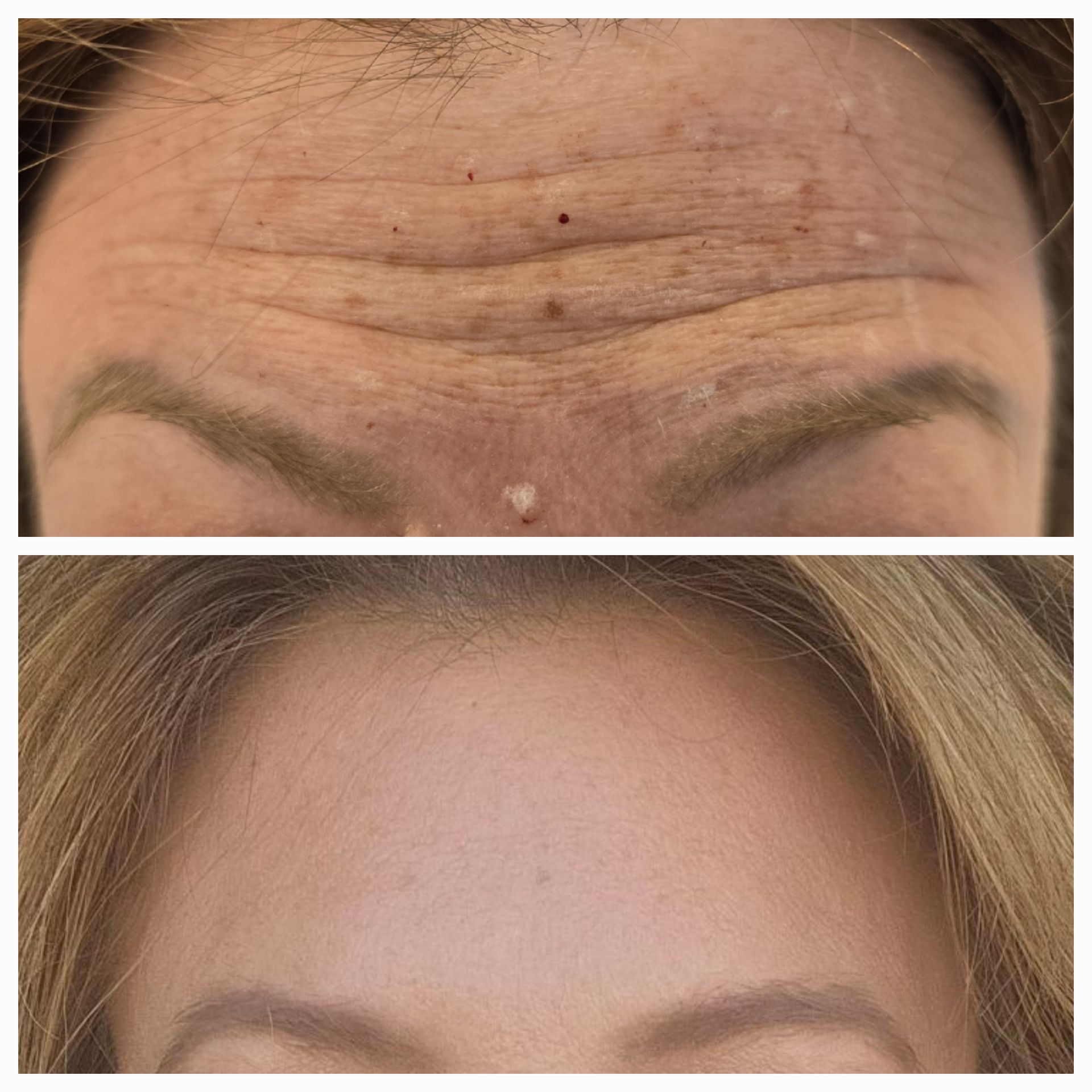 Close-up comparison of forehead before and after, showing fewer wrinkles and smoother skin.