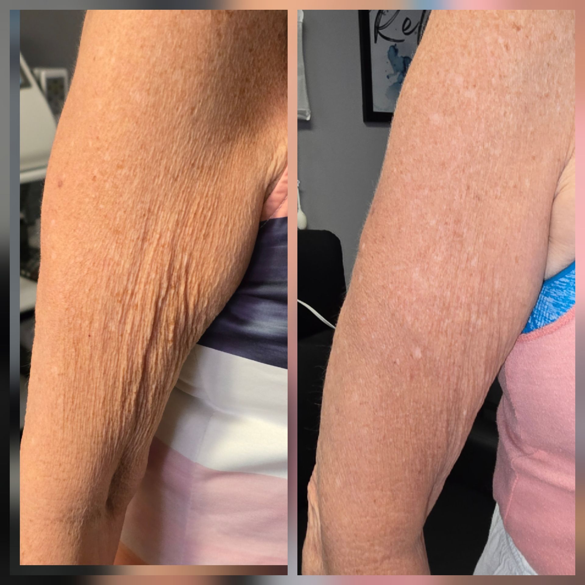 Side-by-side close-ups of an upper arm before and after smoother-looking skin texture