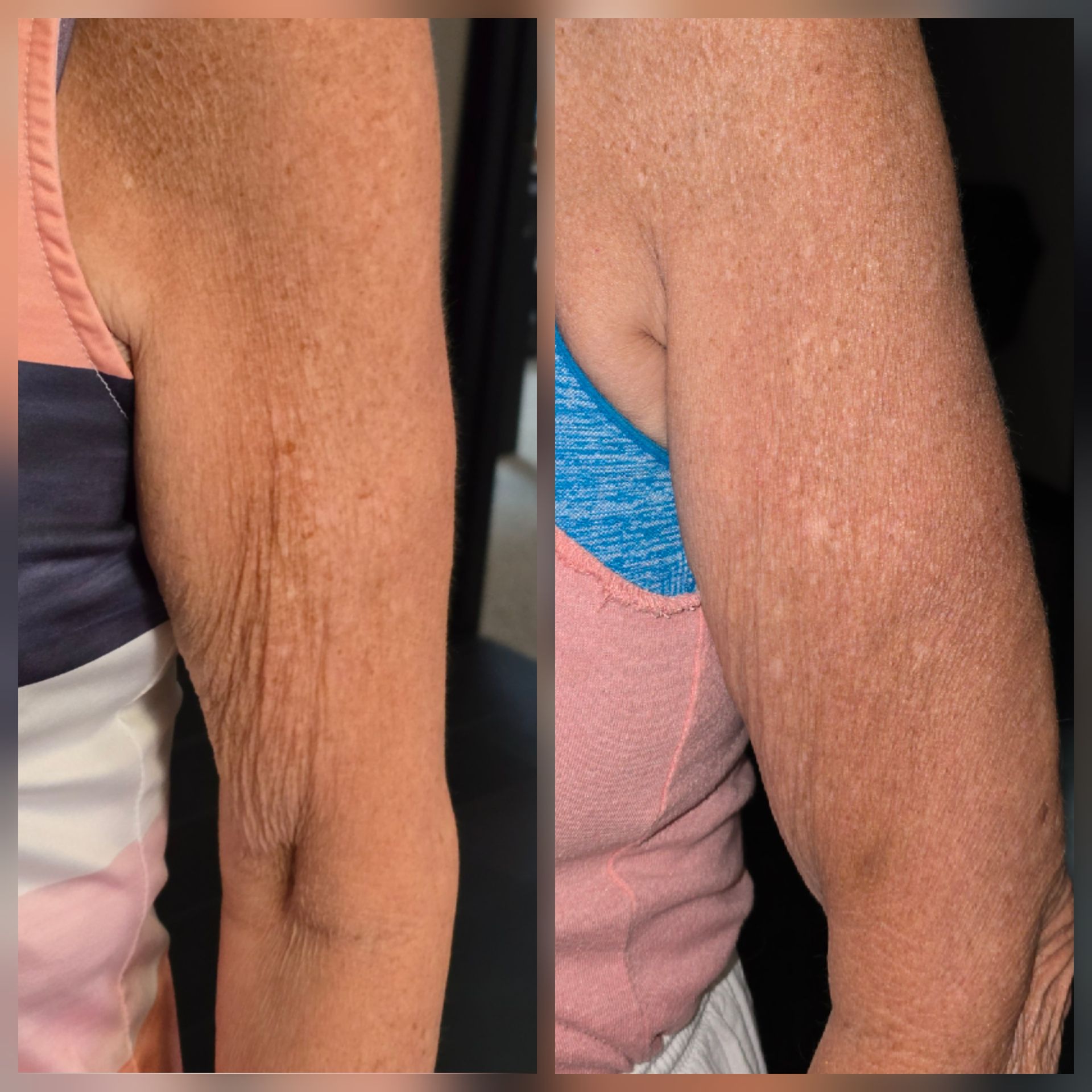 Close-up of a hairy forearm shown in side-by-side before-and-after views