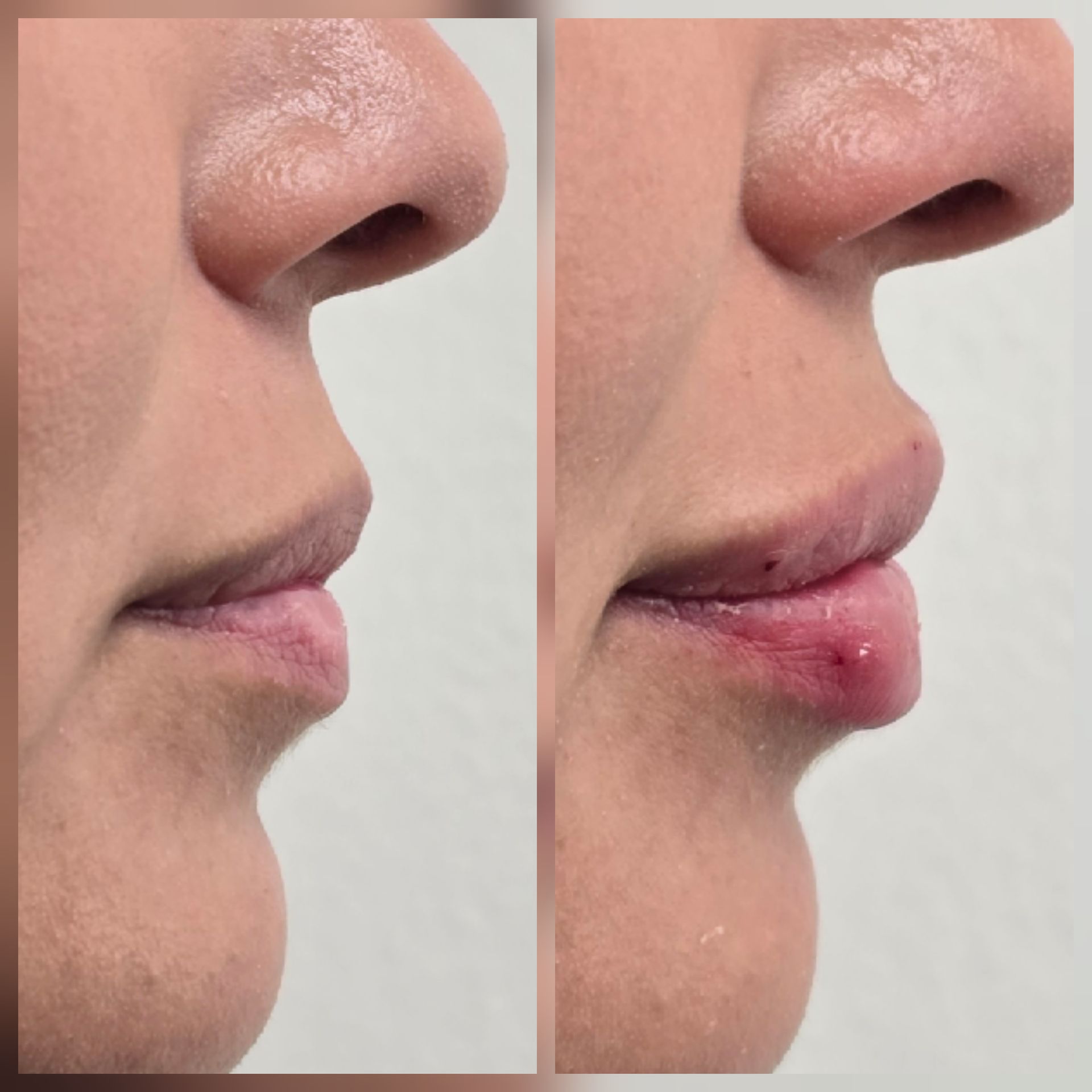 Side-by-side close-ups of a person’s nose and lips, with a reddish swollen spot on the lower lip in the right image