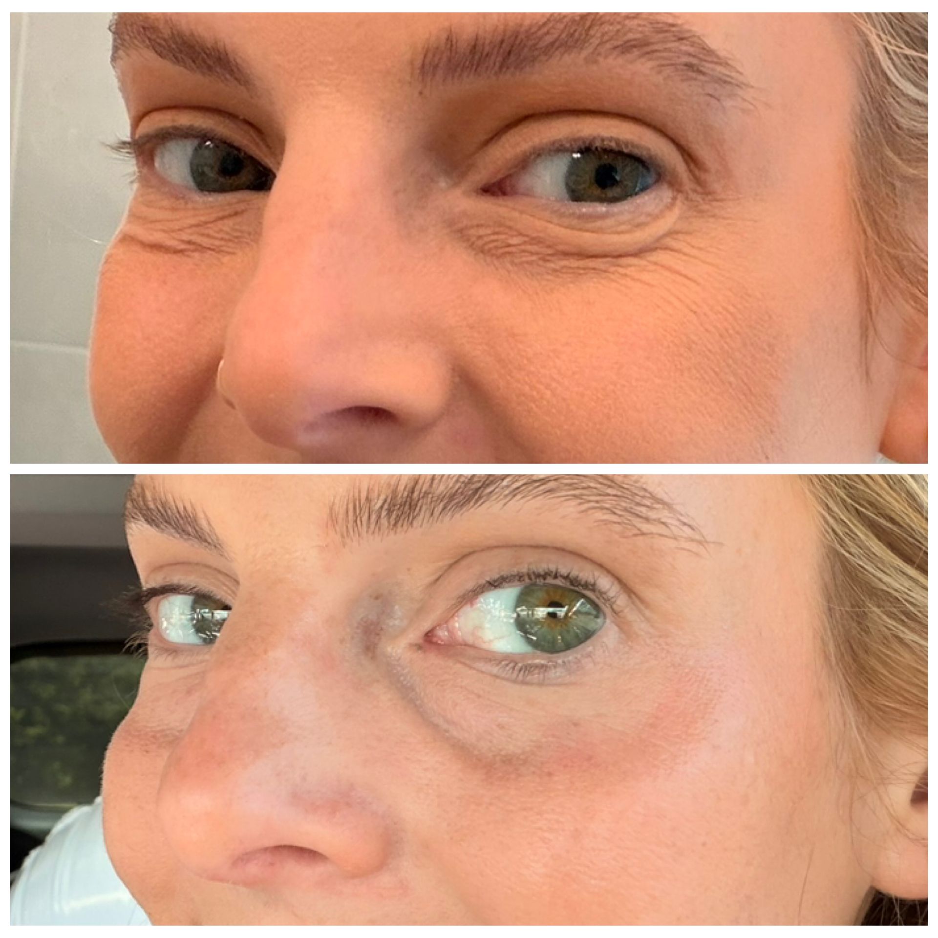 Side-by-side close-ups of an eye area, showing under-eye discoloration before and after.