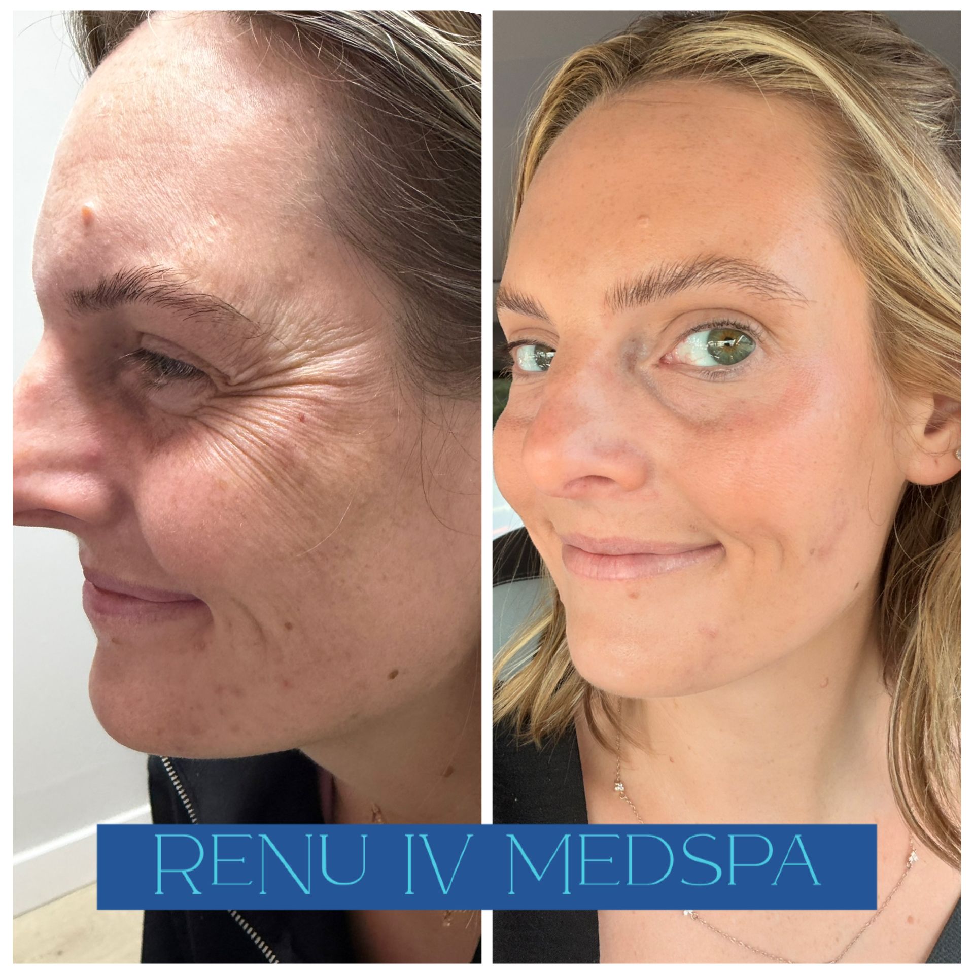 Side-by-side facial profile and front views of a woman, with “RENU IV MEDSPA” banner below