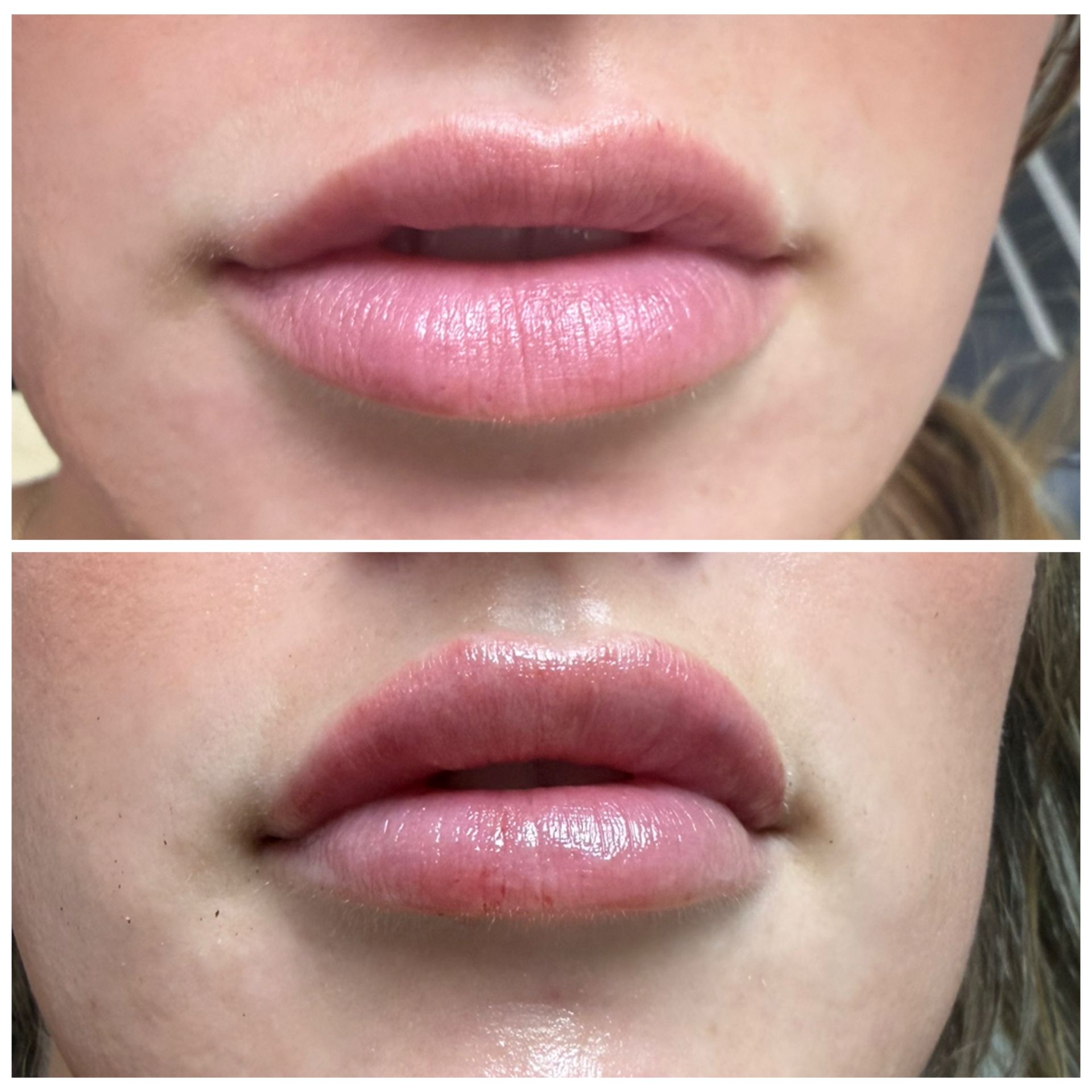 Close-up of lips before and after lip filler treatment, showing increased fullness and glossiness.