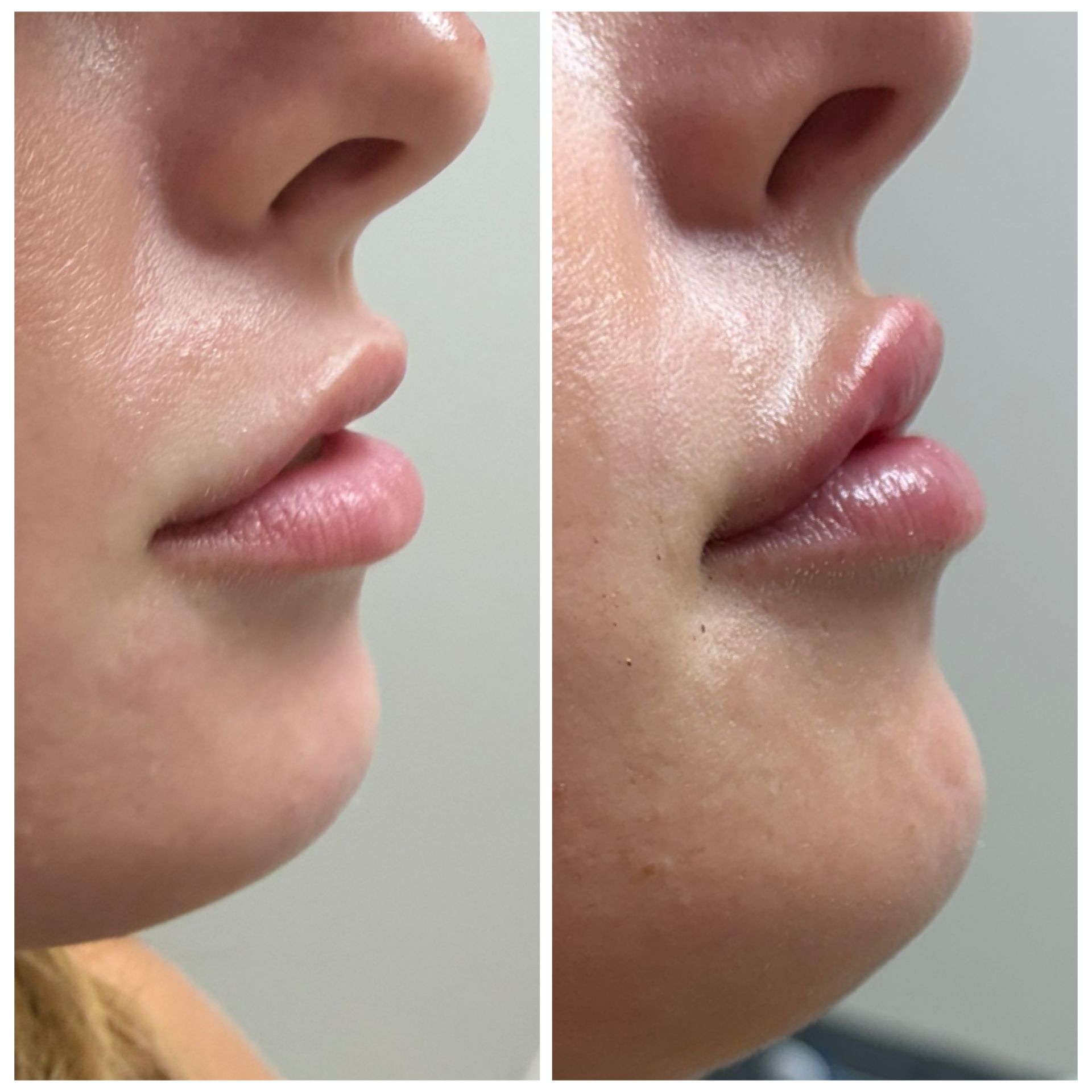 Side-by-side close-up profile views of a person's nose and lips, showing before and after lip enhancement.