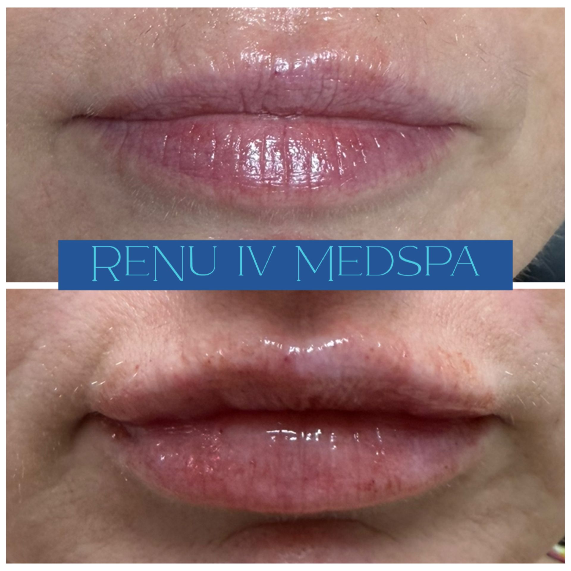 Before-and-after close-up of lips with a centered “Renu IV Medspa” banner.