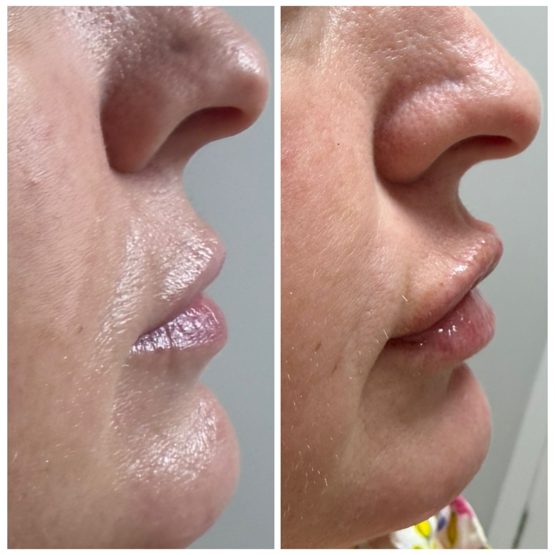 Side-by-side close-up profile of a person's nose and lips, showing slight skin texture and shine.