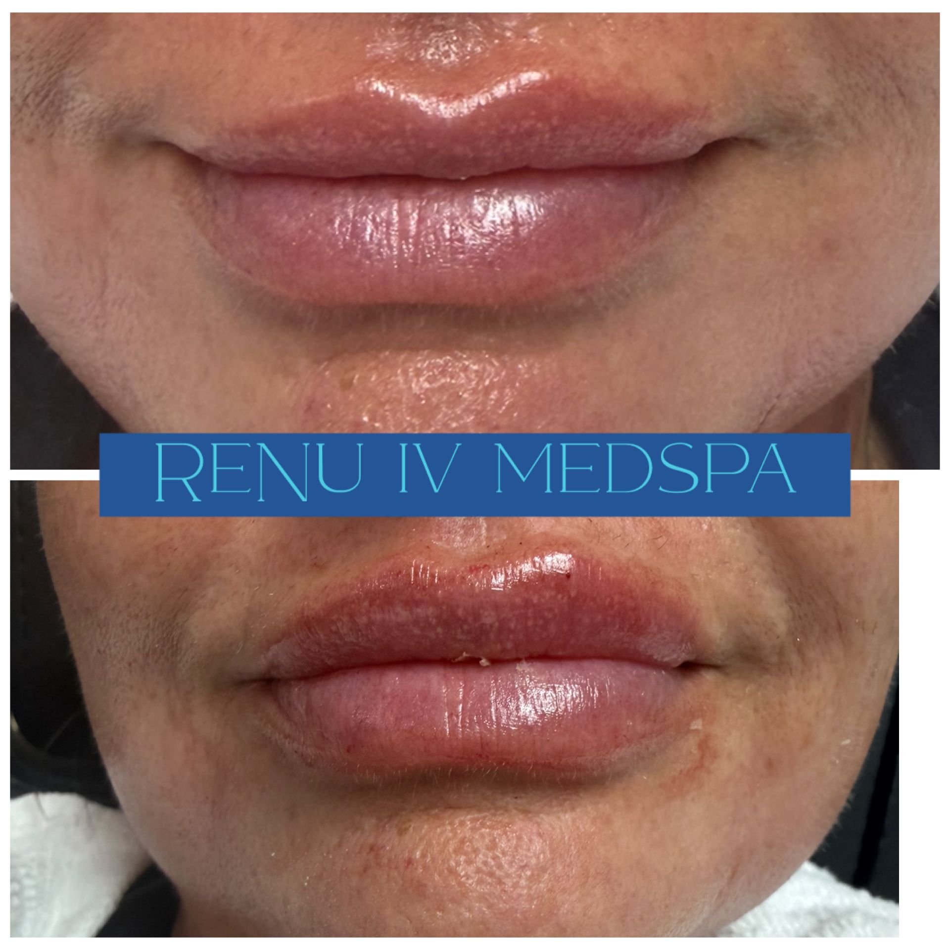 Before-and-after close-up of lips after lip filler, with a RENUV MEDSPA banner across the center