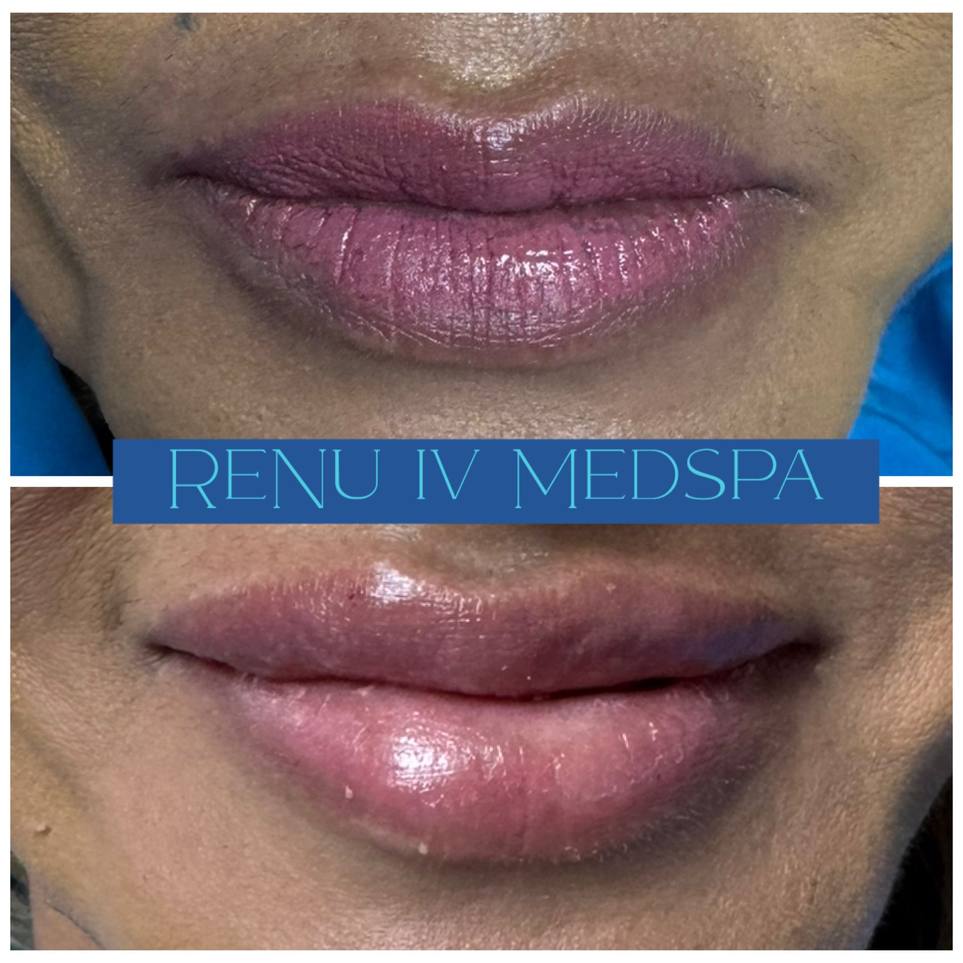Before-and-after close-up of lips with visible fullness and shine; blue “RENU IV MEDSPA” banner across center
