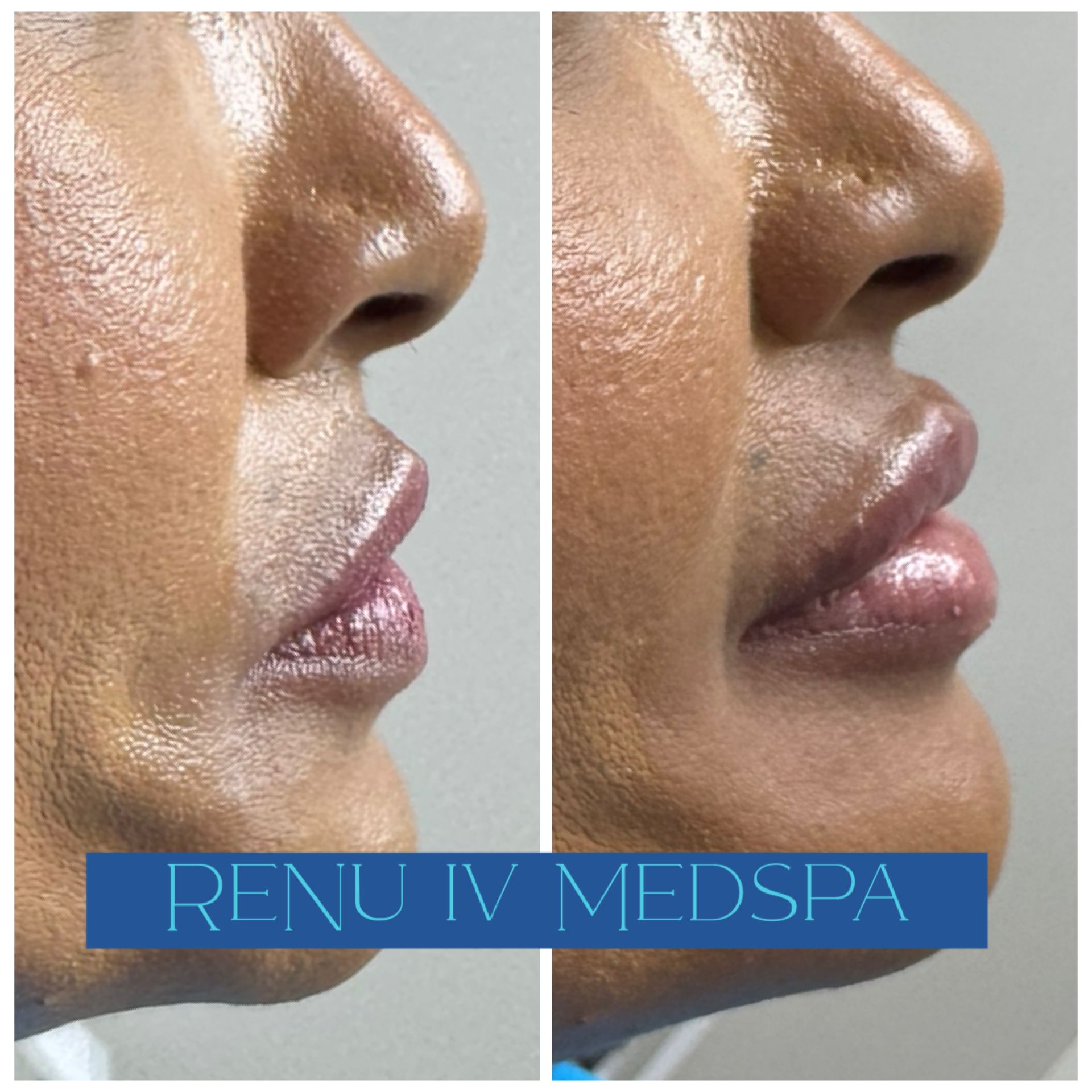 Before-and-after side profile of lips and nose, showing fuller lips; “Renu IV Medspa” watermark.