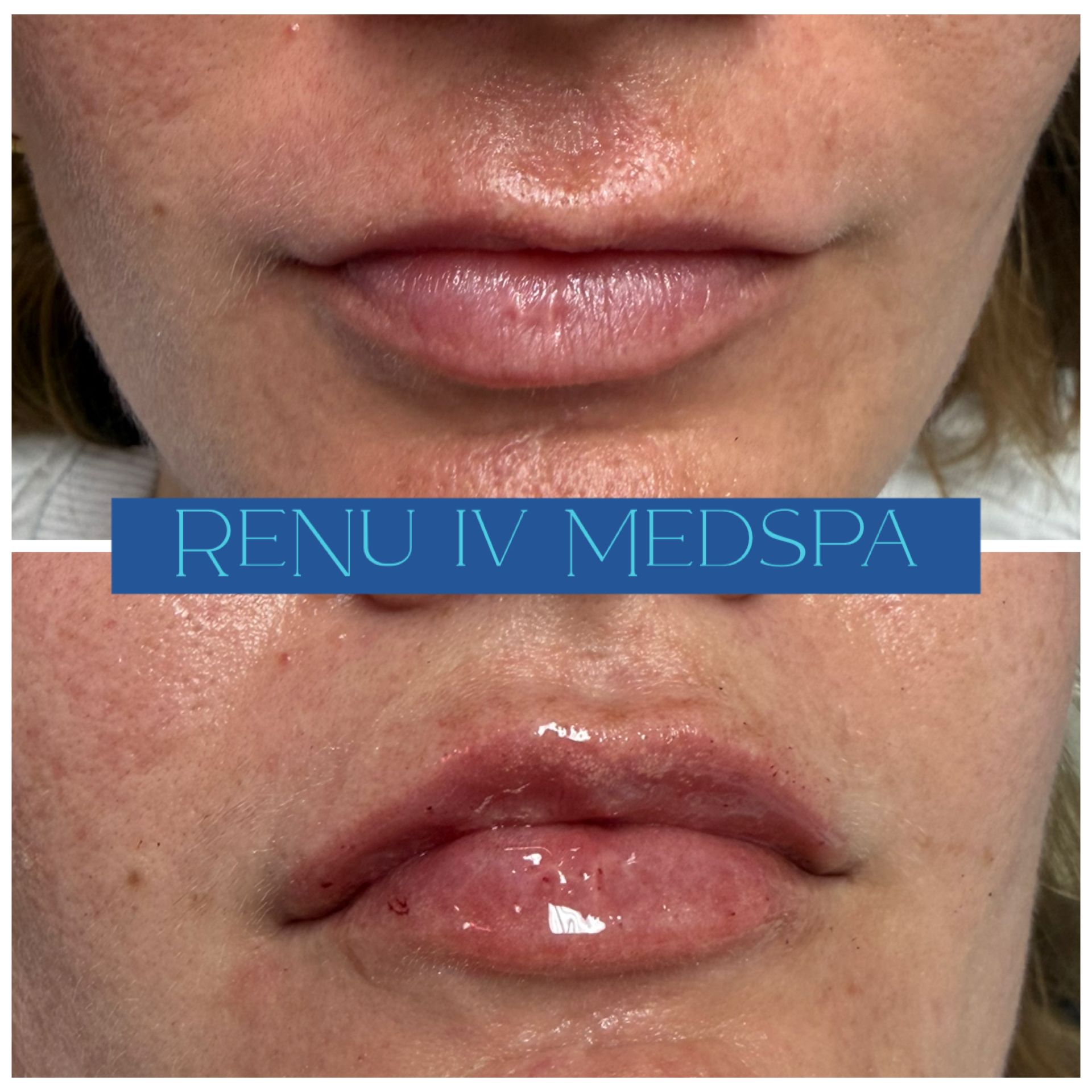 Before-and-after close-up of lips with a blue “RENU IV MEDSPA” banner between the images