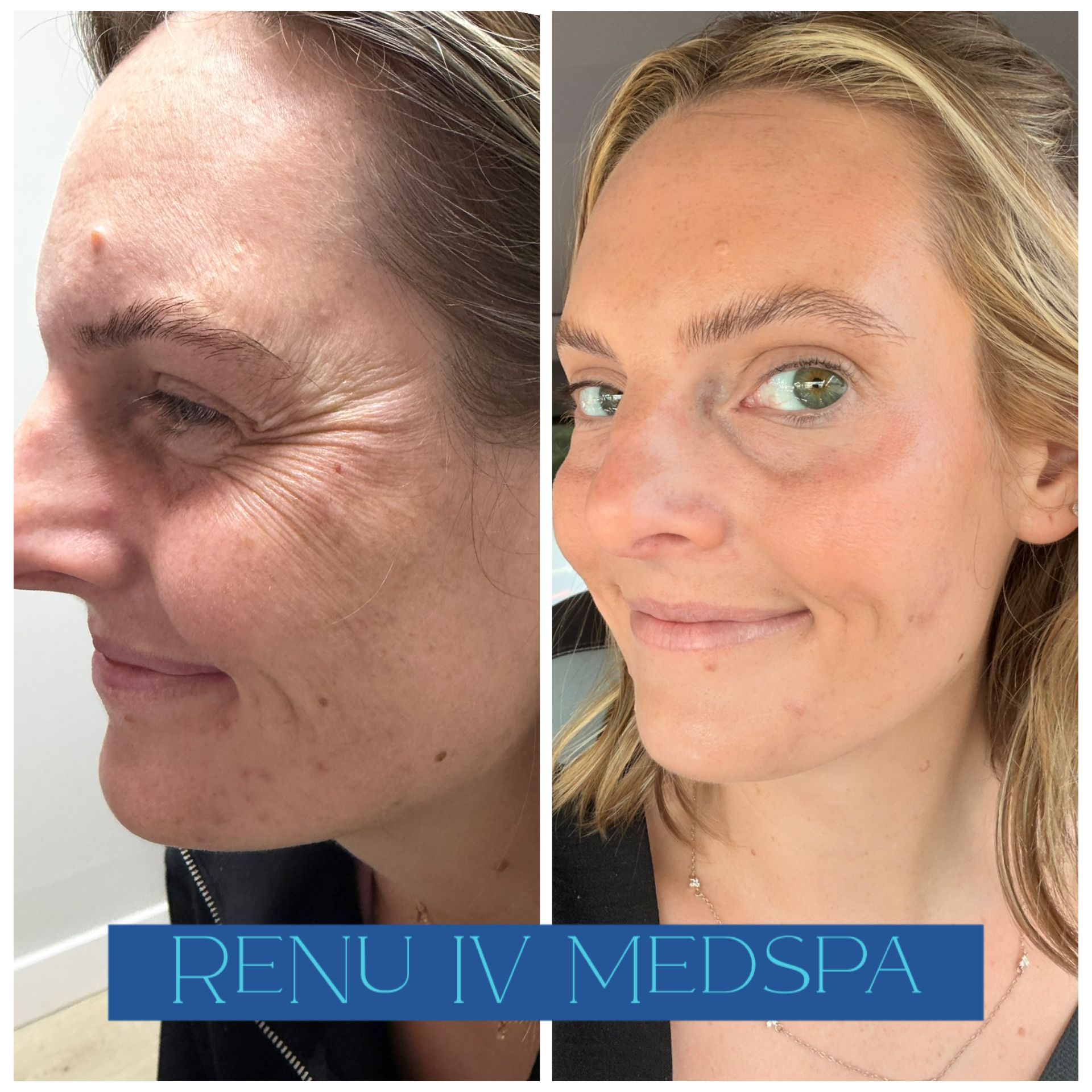 Side-by-side facial before-and-after at RENU IV MedSpa, showing fewer wrinkles and smoother skin