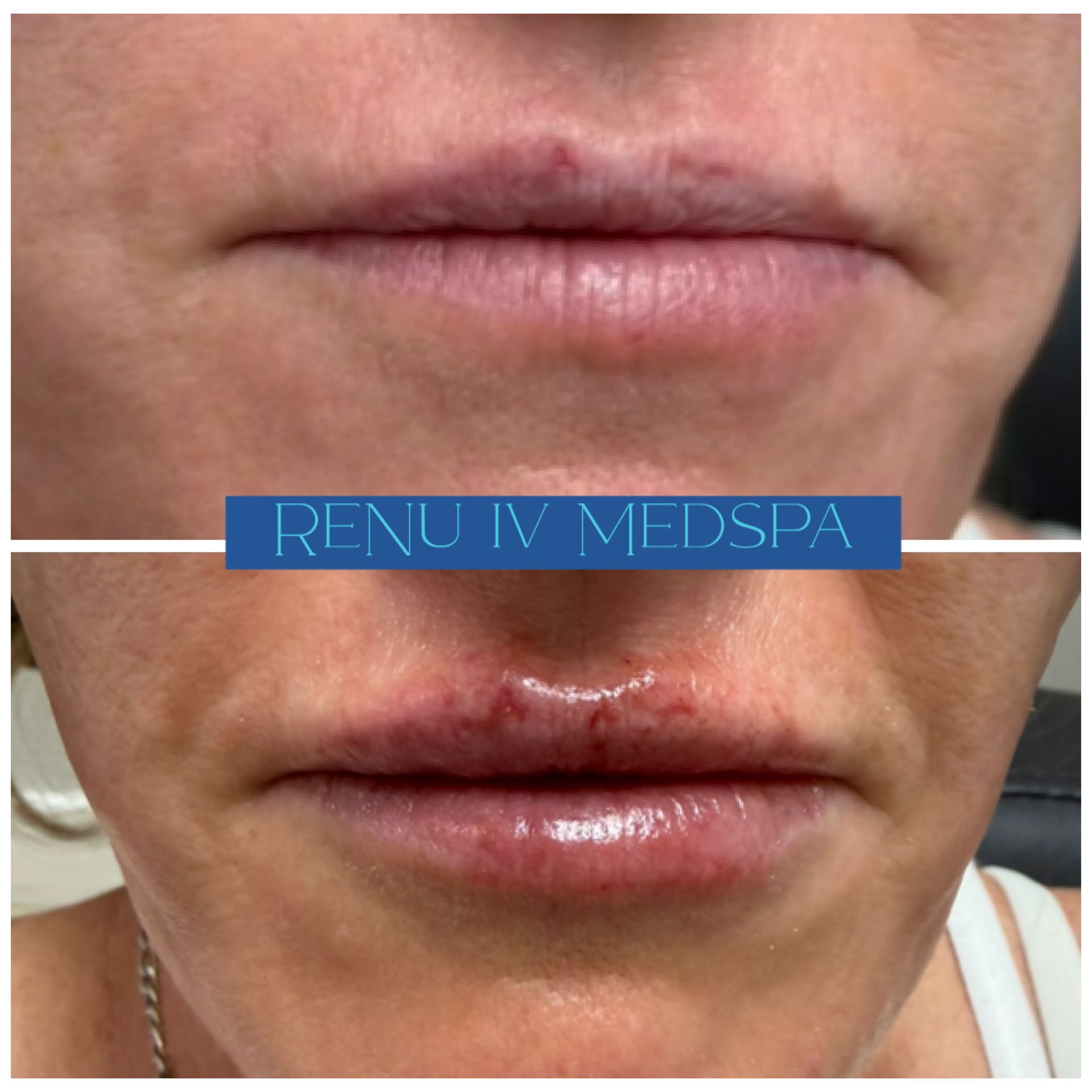 Before-and-after close-up of lips, with the lower image showing a glossy treated lip and the upper image untreated.