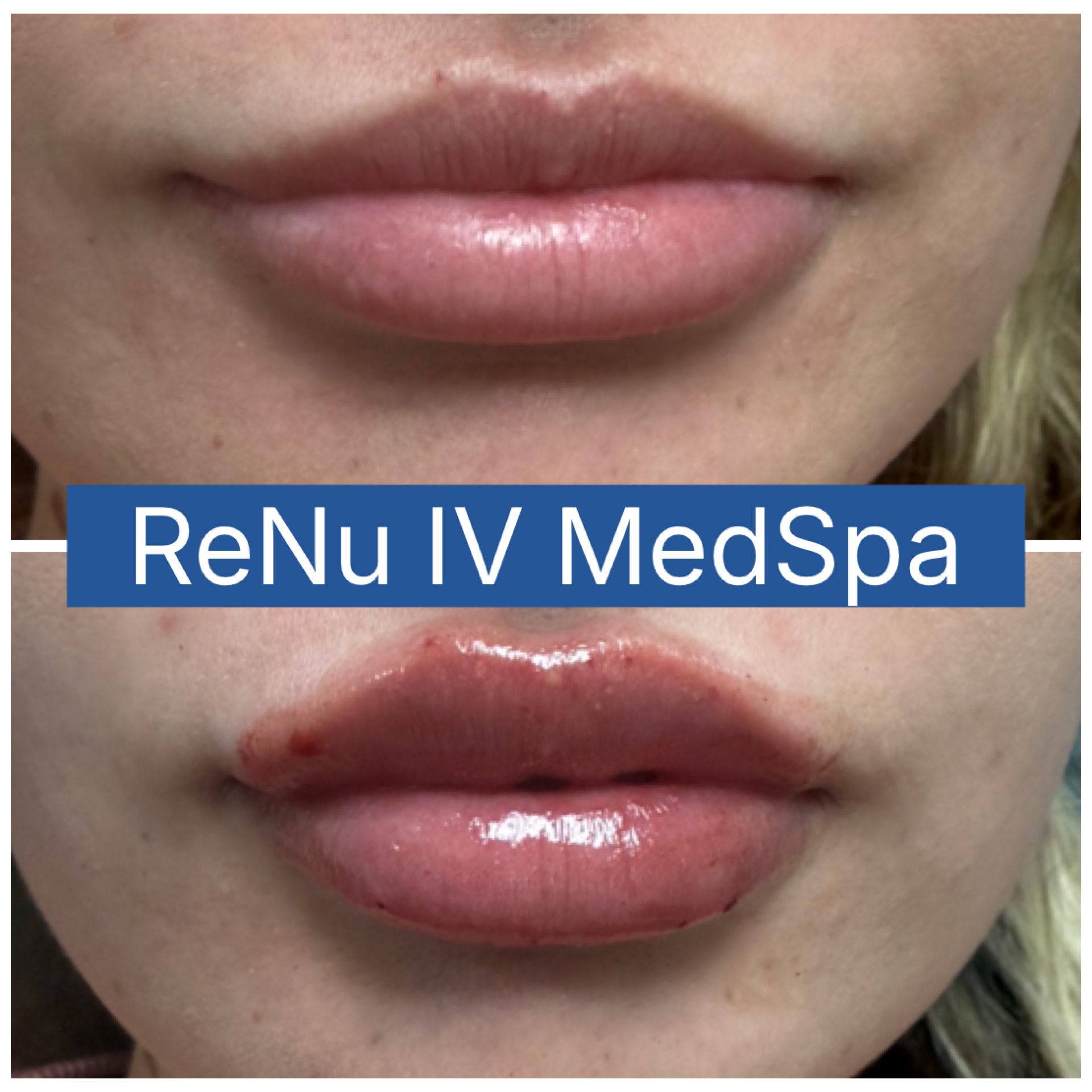 Before-and-after close-up of lips, with a small red spot on the lower lip in the after image.