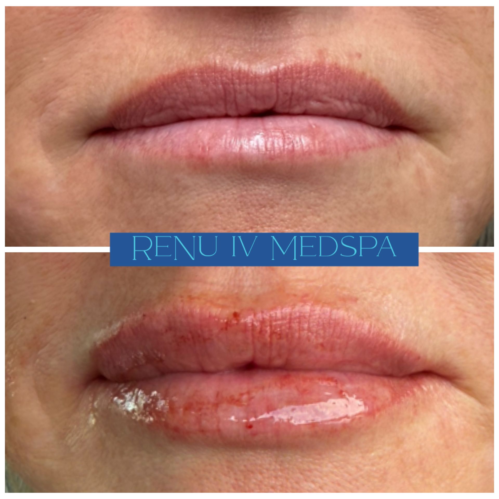 Before-and-after close-up of lips, showing dry upper lip and glossy, healing lower lip with ointment.