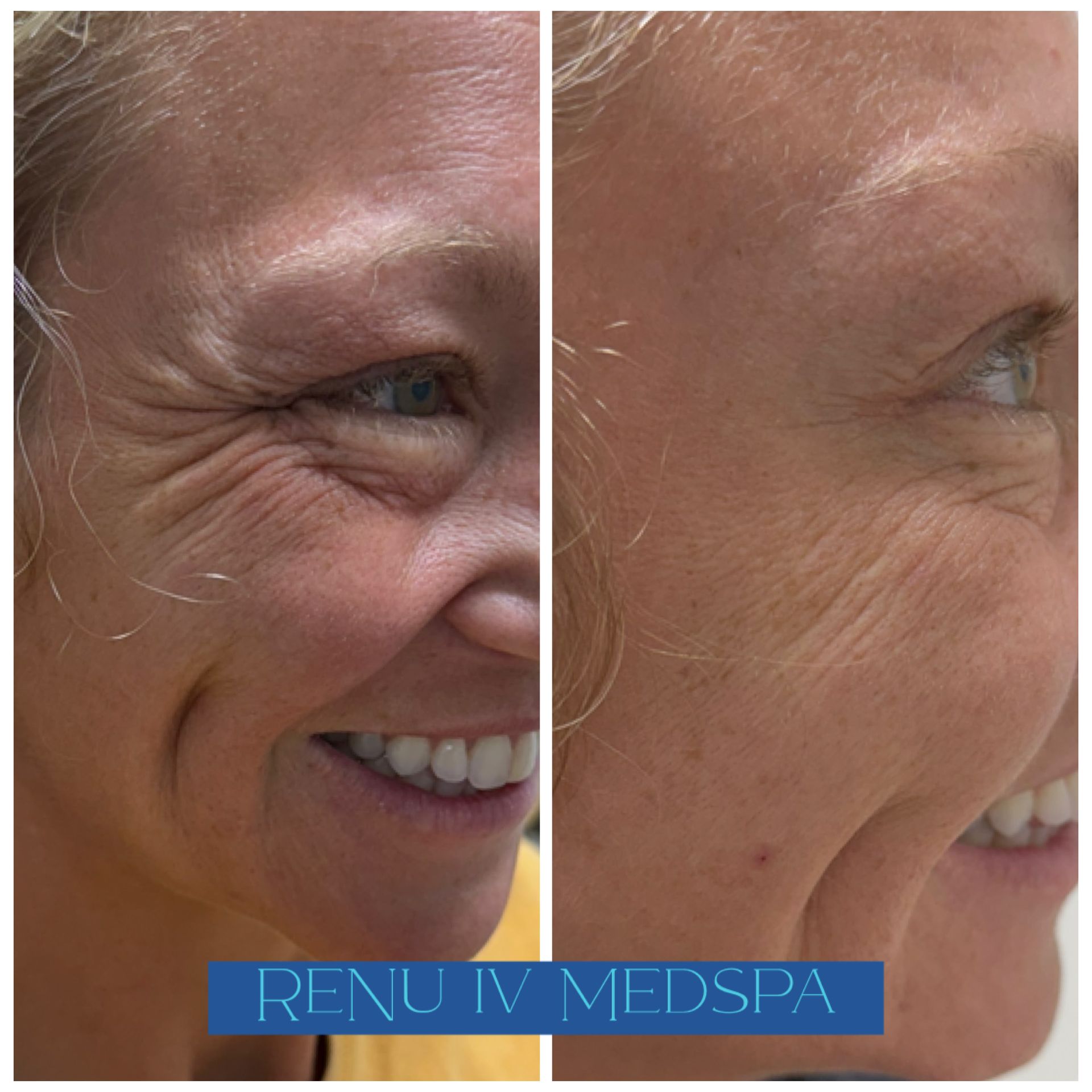 Side-by-side close-up of a smiling face before and after facial treatment