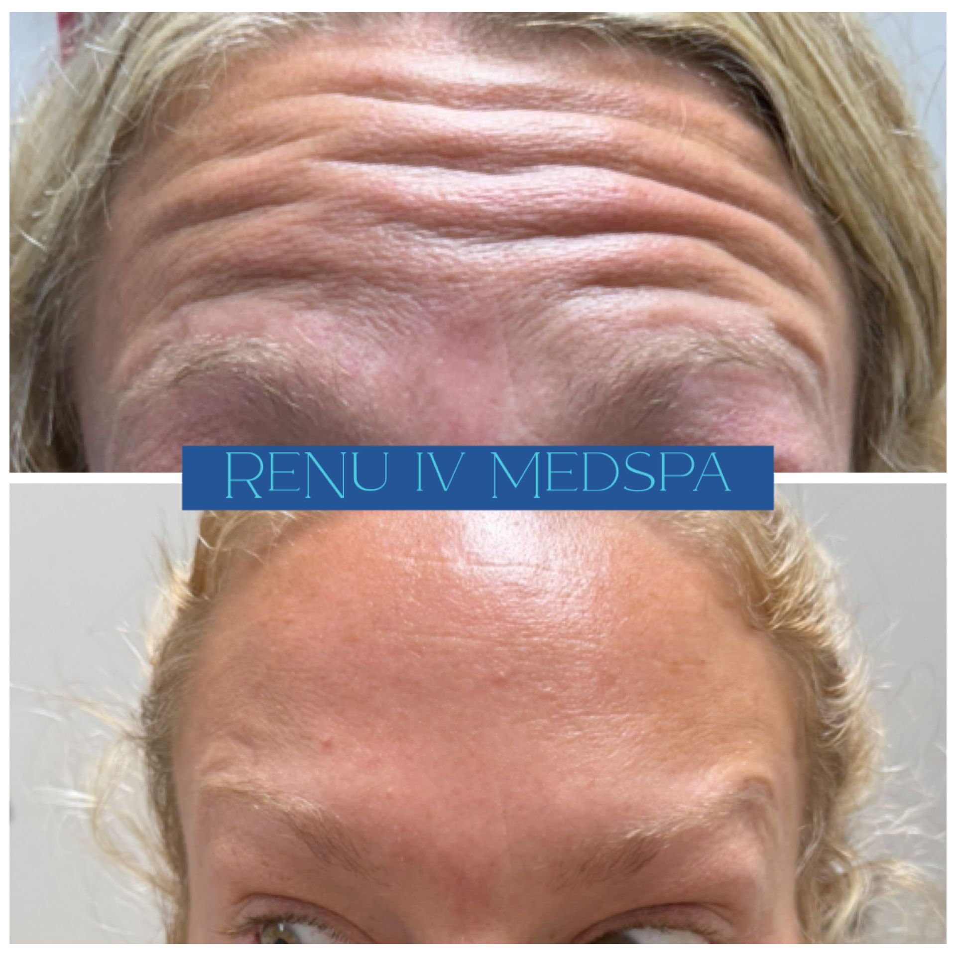 Close-up before-and-after forehead wrinkles, with a blue 