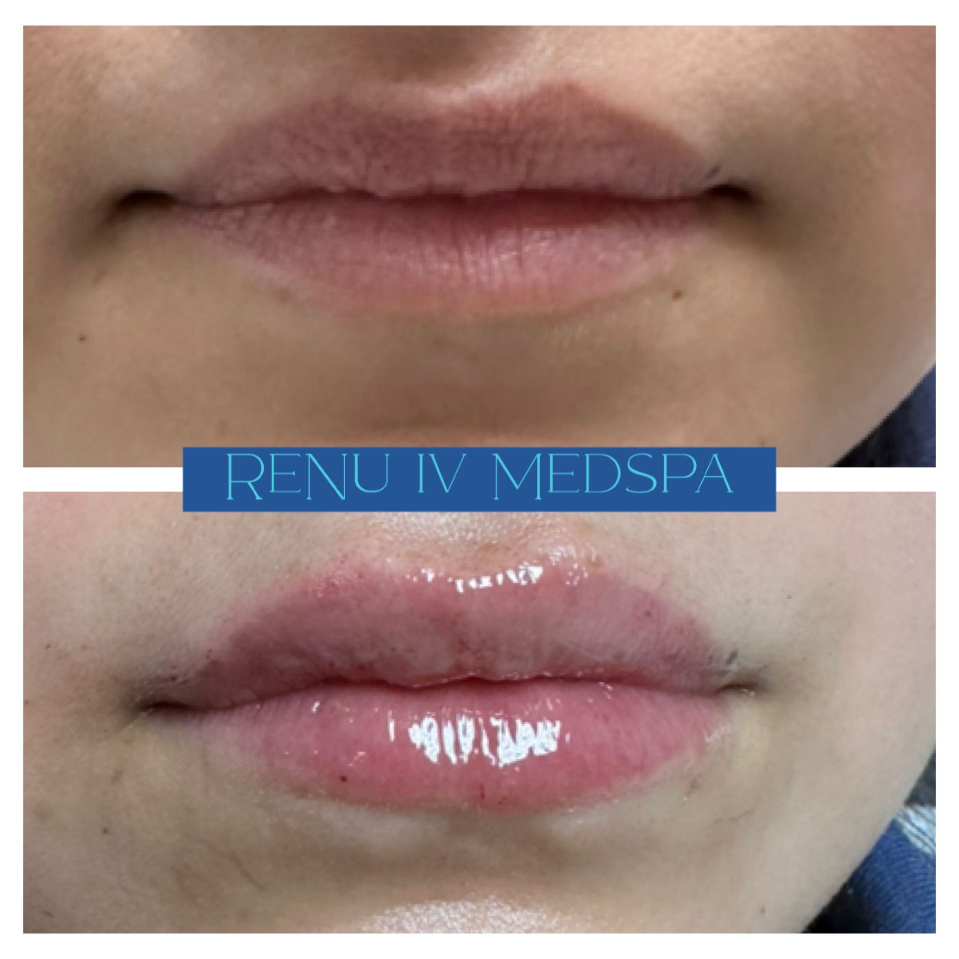 Close-up of lips before and after treatment, showing glossier, fuller lower lip on bottom.