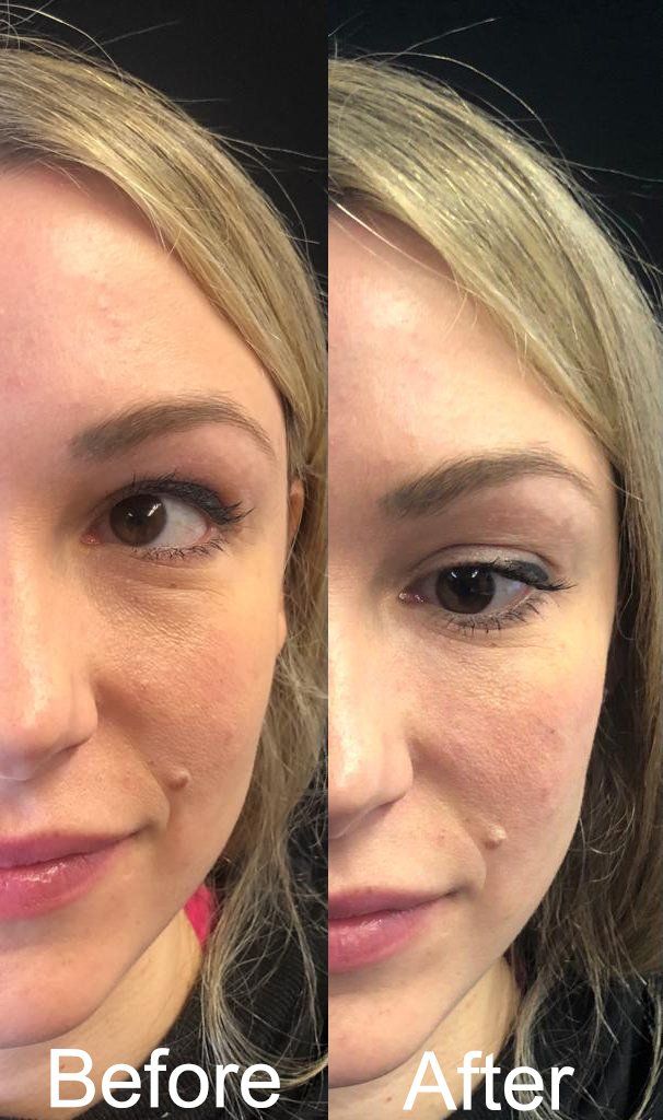 MicroCannula Injection Of UnderEye Fillers For Tear Troughs