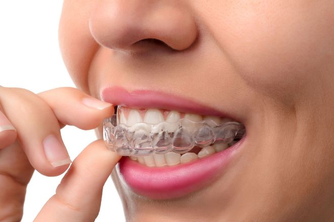 Close-up of a person inserting a clear aligner into their teeth