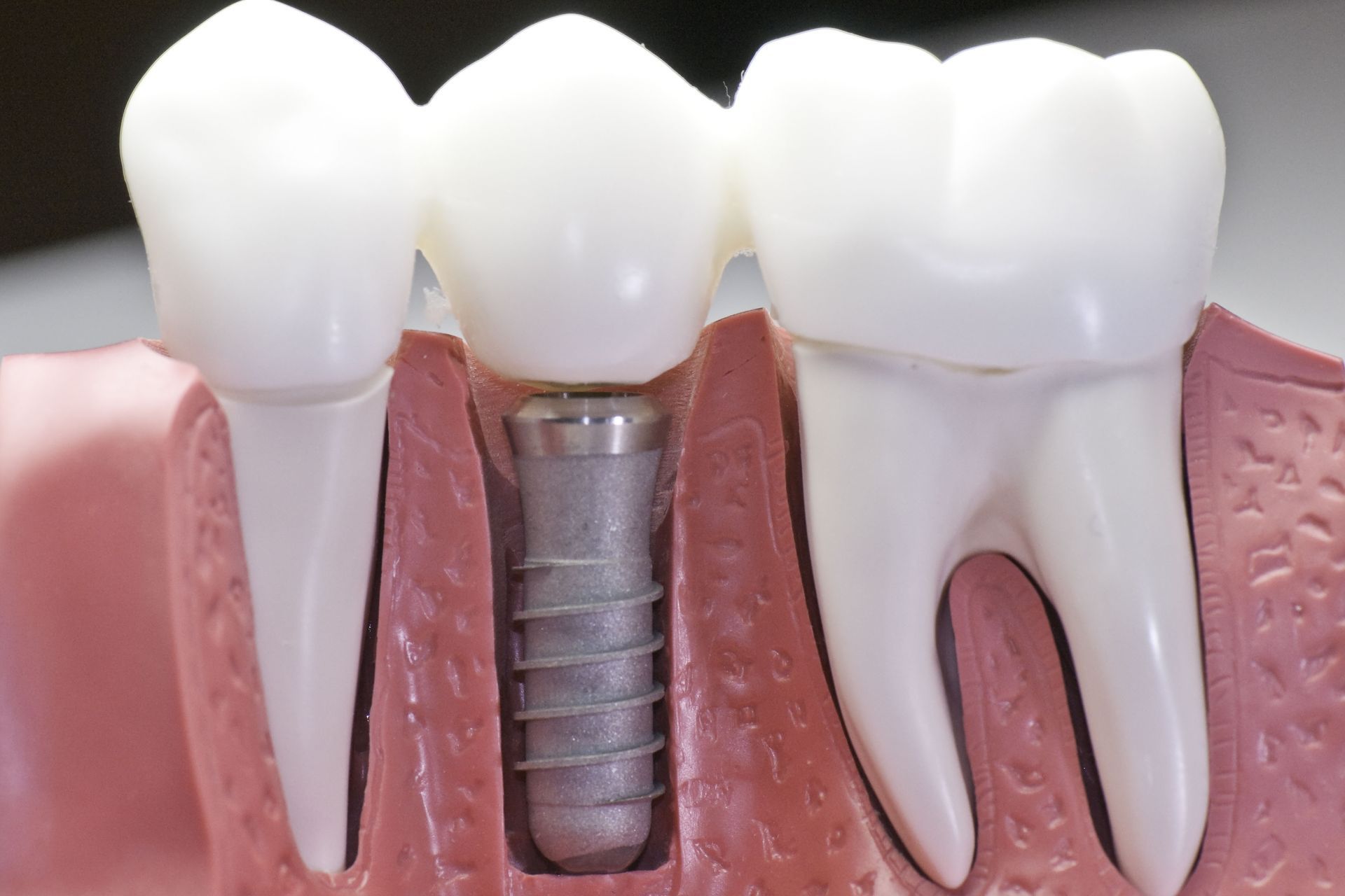Dental implant between two white crowns on a gum model