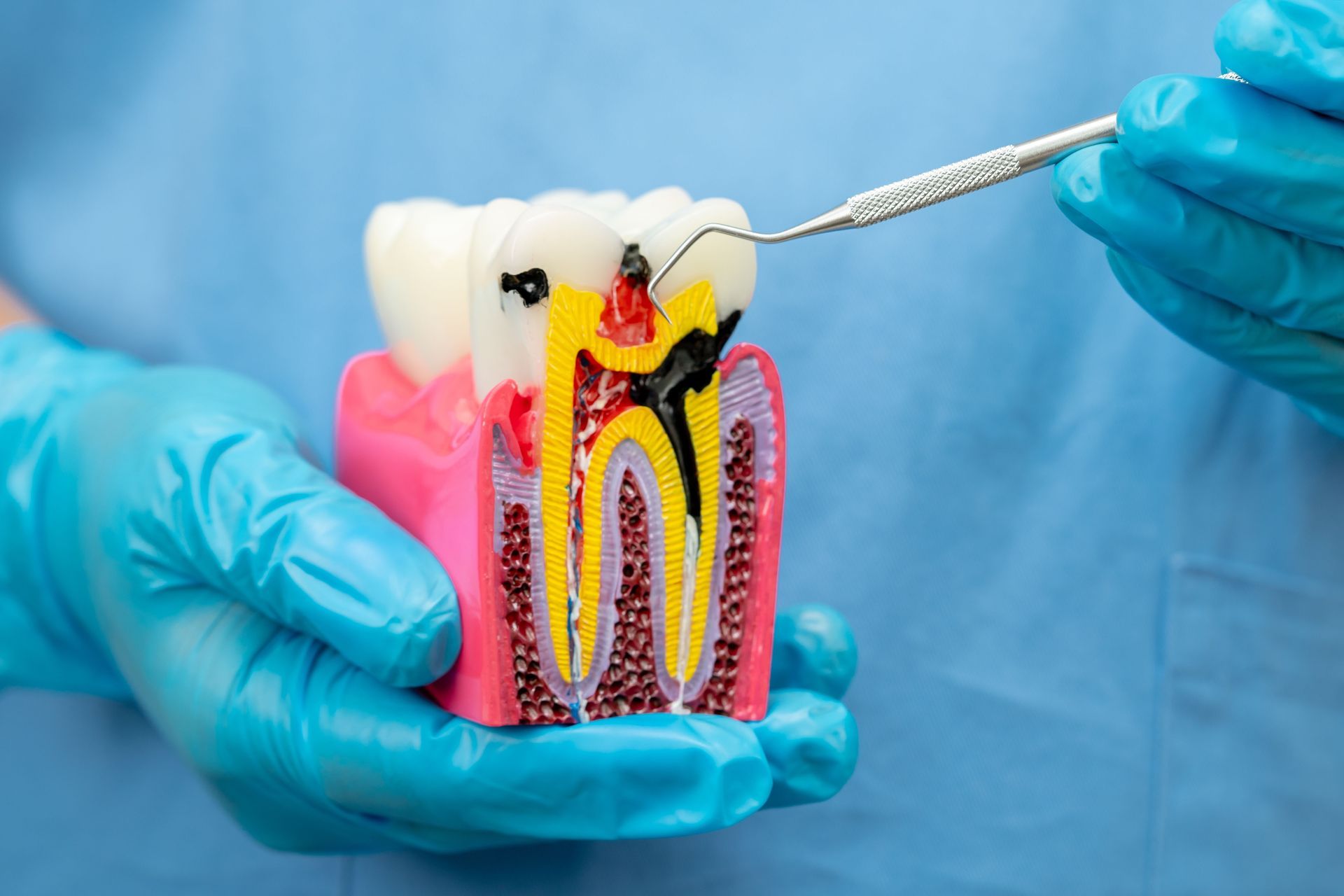 Gloved hands demonstrating a dental model with exposed tooth roots and a dental tool