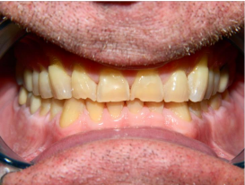 Full mouth reconstruction before - patient 1