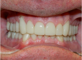 After fixing the teeth